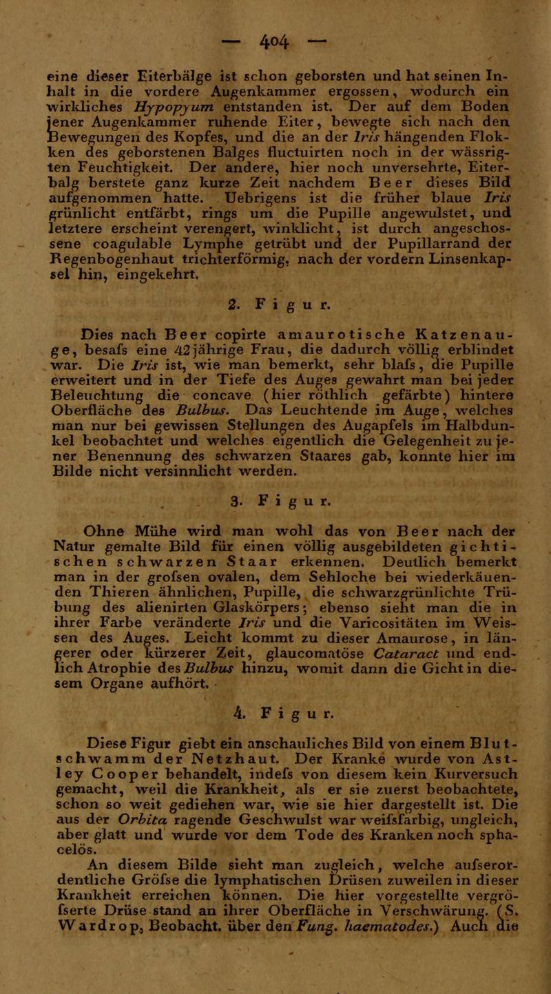 eine dieser Eiterbälge ist schon geborsten und hat seinen In- halt in die vordere Augenkammer ergossen, wodurch ein wirkliches Hjpopyum entstanden ist. Der auf dem Boden jener Augenkammer ruhende Eiter, bewegte sich nach den feewegungen des Kopfes, und die an der Iris hängenden Flok- ken des geborstenen Balges fluctuirten noch in der wässrig- ten Feuchtigkeit. Der andere, hier noch unversehrte, Eiter- balg berstete ganz kurze Zeit nachdem Beer dieses Bild aufgenommen hatte. Uebrigens ist die früher blaue Iris grünlicht entfärbt, rings um die Pupille angewulstet, und letztere erscheint verengert, winklicht, ist durch angeschos- sene coagulable Lymphe getrübt und der Pupillarrand der Regenbogenhaut trichterförmig, nach der vordem Linsenkap- sel hin, eingekehrt, 2. Figur. Dies nach Beer copirte amaurotische Katzenau- ge, besafs eine 42jährige Frau, die dadurch völlig erblindet war. Die Iris ist, wie man bemerkt, sehr blafs, die Pupille erweitert und in der Tiefe des Auges gewahrt man bei jeder Beleuchtung die concave (hier röthlich gefärbte) hintere Oberfläche des Bulbus. Das Leuchtende im Auge, welches man nur bei gewissen Stellungen des Augapfels im Halbdun- kel beobachtet und welches eigentlich die Gelegenheit zu je- ner Benennung des schwarzen Staares gab, konnte hier im Bilde nicht versinnlicht werden. 3. Figur. Ohne Mühe wird man wohl das von Beer nach der Natur gemalte Bild für einen völlig ausgebildeten gichti- schen schwarzen Staar erkennen. Deutlich bemerkt man in der grofsen ovalen, dem Sehloche bei wiederkäuen- den Thieren ähnlichen, Pupille, die schwarzgrünlichte Trü- bung des alienirten Glaskörpers; ebenso sieht man die in ihrer Farbe veränderte Iris und die Varicositäten im Weis- sen des Auges. Leicht kommt zu dieser Amaurose, in län- gerer oder kürzerer Zeit, glaucomatöse Cataract und end- lich Atrophie des Bulbus hinzu, womit dann die Gicht in die- sem Organe aufhört. k. Figur. Diese Figur giebt ein anschauliches Bild von einem Blu t- schwamm der Netzhaut. Der Kranke wurde von Ast- ley Cooper behandelt, indefs von diesem kein Kurversuch gemacht, weil die Krankheit, als er sie zuerst beobachtete, schon so weit gediehen war, wie sie hier dargestellt ist. Die aus der Orbita ragende Geschwulst war weilsfarbig, ungleich, aber glatt und wurde vor dem Tode des Kranken noch spha- celös. An diesem Bilde sieht man zugleich, welche ausseror- dentliche Gröfse die lymphatischen Drüsen zuweilen in dieser Krankheit erreichen können. Die hier vorgestellte vergrö- fserte Drüse stand an ihrer Oberfläche in Verschwärung. (S. Wardrop, Beobacht, über den Fang, haematodes.) Auch aie