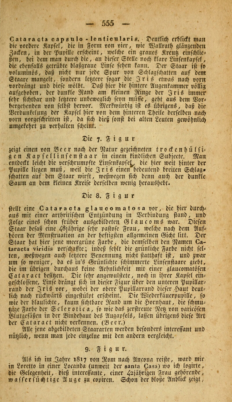 Cataracta capsulo -lenticularis. Deutltd) crfcfttft matt bte »orbere tfapfel, bte in 3wm »Ott vier, wie SSMraty glänjenben 3acfen, in ber Pupille erfdjetnt, welche ein grauet ßreufs cinfcfyfie* jfen, bei bem man burd) bte, an biefer ©rede nod) Ffare SinfenFapfef, bic ebenfalls getrabte blaftgraue Stnfe fetyen Faun. Der ©taar ift fo voluminös, bafj nid)t nur jebe ©pur von ©d)lagfd)atten auf htm ©taare mangelt/ fonbern festere fogar bte 3riS ?tvoa$ nad) »orrt «orbrängt unb biefe wölbt. Daf? liier bte wintere 2lugenFammer »öffig aufgehoben, ber bunFfe 9?anb am Keinen 9ttnge ber 3riS immer fet>r ftdjtbar unb festere unbeweglich fetjn muffe, gebt aus bem 33or* fcergebenben »on felbft fieroor. 5D?erFwürbtg ift e$ übrigens, ba^ bic SSerbunFelung ber jtapfel l;ter »on oem Hinteren Xfjetle berfelben naefy vorn oorgefdritten ift, ha fidj bief? fonft bei alten Stuten gewötmltd) umgeFetyrt su »erhalten fcfycinr. Die 7. % t g u r jetgt einen oon 23 e e r nad) ber 9?atur geleugneten t r 0 tf e n £ ü lf u gen Äapfclttnfenfraar tu einem Finblicfyen ©ubjeete. Wian entbeeft leicht bte »erfdjrumpfte StnfenFapfe^, bie frier mit hinter ber «Pupille liegen muf?; weil bte 3 r i 3 einen bebeutenb bvdten ©cfytag» fdfjatten auf ben ©taar wirft, wefjwegen ftcfy benn aud) ber bunFfe ©aum an htm Keinen Greife berfelben wenig tyerauS^ebt. Die 8. $ i g u r frettt eine Cataracta glaueomatosa »or, bie frier burd)* attS mit einer artljrittfdjen Crnrjünbung in SSerbinbung jranb, unb gofge eineS fdjon früher auSgebitbeten ÖUaucomS war. Dtefen ©taar befaf? eine 48jä^rigc fe^r paftofe ftrau, welcfye nad) htm 2lufc £ören ber 50?enflruatton an ber fjeftigften allgemeinen &iü)t litt. Der (btaar f)at frier jene meergrüne ftarbe, hu bemfefben ben tarnen Ca- taracta viridis p er fd) äffte; inbefj fepft bie grünlicfye ftarbe nidjt fei* ten, weswegen aud) festere Benennung nid)t ftattljaft ift, unb swar um fo weniger, ha eS tn1S @rünftd)te flimmerte Sinfenftaare giebt, bie im übrigen burdjauS Feine 2tefmftd)Feit mit einer gfaueomatöfen @ataract beft^en. Sie fef)r angewulftete, nod) in ü)rer Zapfet ein- gefcfyfoffene, Stnfe brängt ftd) in biefer ftigur über htn unteren ^upitlar- ranb ber 3riS oor, wobei ber obere $upiflarranb biefer -Jpaut htuU tid^ nad) rücfwärtS eingeftüfpt erfdjeint. Die 2öieberFäuerpupi(le, fo wie ber bläuliche, Faum ftcfytbare 3?anb um bie |>orn^attt, bie fcfymu- ^tge ^arbe ber ©clerotica, fo wie oa$ jerftrettte 9?e£ oon oarico'fen Blutgefäßen in ber SSinbe^aut be^ Slugapfef^, raffen übrigens biefe 2lrfc ber (Jataract nic^t »erFennen. (33ecr.) Mffe jene abgebilbeten ©taararten werben befonberS tntereffant unb nü£lid), wenn man jebe einsetne mit tm anbern »ergleidjr. 9. % i g u r. 2113 id) im 3a^re 1817 oon 9?om nad) 5lncona reifte, warb mir in Soretto in einer Socanba (unweit ber santa Casa) wo id) fogirte, bte @etegenf)eit, biefj intereffante, einer 42jäf)rigen ^rau gejwrenbc, waff'erfü^tige 2(uge su copiren. ©d^on ber bfo|e Sfnbftcf jetgtx