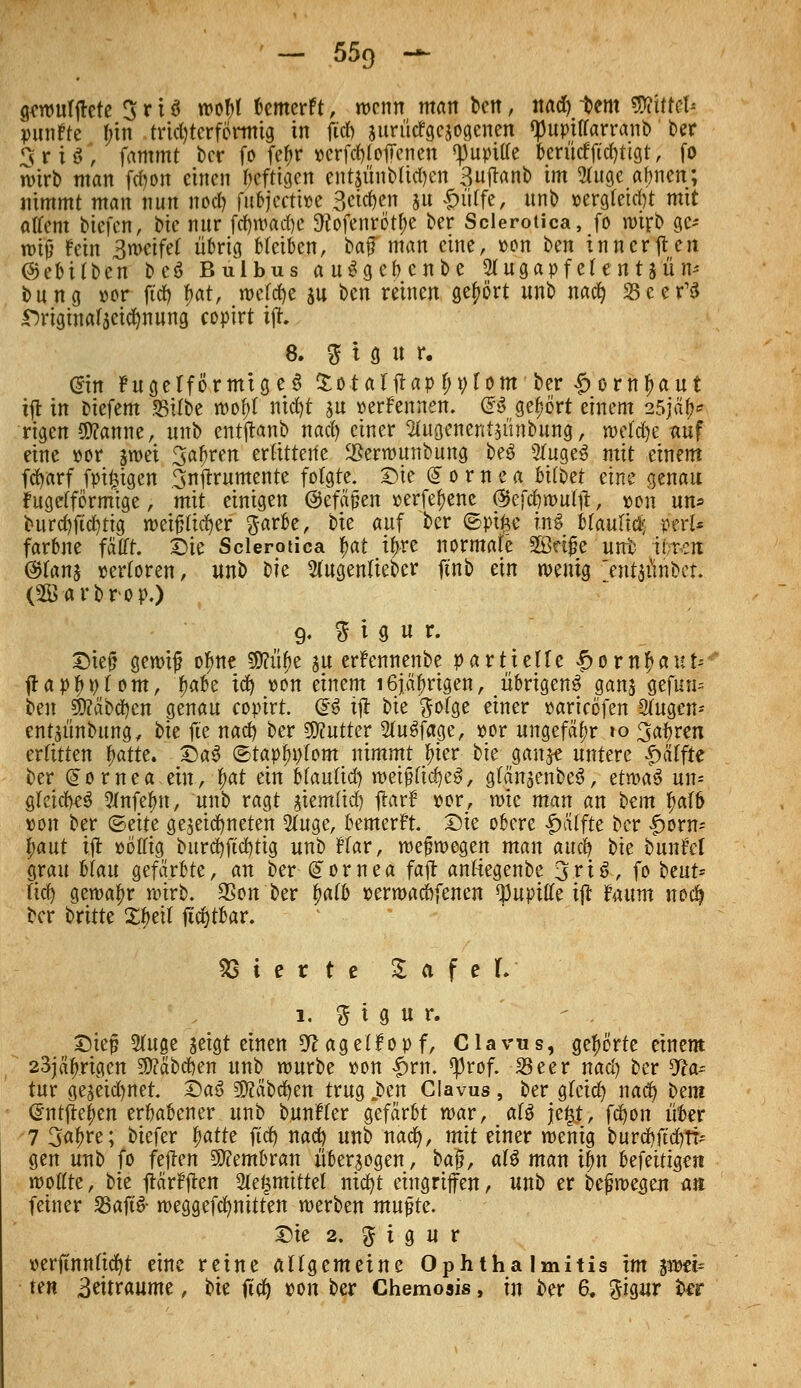gewnlffete 5 r 13 wof)l »emerft, wenn man ben, nad) tem Mtttk punfte l;in trichterförmig in fiel) jurücfgcsocjenen tyuptlforranb ber $ r i $*, fammt ber fo fefir »erfd)f offenen ^upitte berücf ficfyttgt, fo wirb man fenon einen Deftigen entjitnbUd)en 3ujt«nb im 2luge abnen; nimmt man nun nod) fubjecti»e Seiten *u £itlfe, ttnb »erg(eid)t mit altem biefen, bie nur fd)wad)c SKofenröttye ber Sclerotica, fo wirb gc- roijj fein 3n>etfet übrig bleiben, ba$ man eine, »cm ben innerffen ©ebilben bc3 Bulbus auSgebcnbe 2(ugapf ele n 13 ü n^ bung »or ftd) l>at, wefd)e ju ben reinen gehört unb nad) Seer'S f>riginal$eicfynung eopirt iff. 8, g t g u r. @m FugelfÖrmtgeS £otalffap l;ylotn ber £ornljaut tff in biefem Silbe wol;t ntd)t su »erFennen. @S gehört einem 25jä|& rigen Spanne, unb entftanb nad) einer 2tugenent$imbung, wetd)e auf eine »or swei Sauren erbitterte SBerrounbung be3 2tuge3 mit einem fcfyarf fpi^tgen 3nffrumente folgte. Sie Cornea ottbet eine genau Fugefförmtge, mit einigen ©efetpen »erfe^ene (5>efd)wulff, »on un* burd)ftd)tig weifjltcfyer ftarbe, bie auf ber ©pifce i.n$ otaulid; wl* farbne fatft. Sie Sclerotica Ut tfjre normale SBrtfie unt iiten ®tant »erloren, unb t)k Slugenlteber ftnb ein wenig 'enthübet. (SBarbrop.) 9. % i g u r. Sief? gewtj? olme SBfitye $u erfennenbe partielle £orn$aut- ffapfc»fom, f)abe idj »on einem i6jä^rigen, übrigens ganj gefun- ben $E?äbd)cn genau eoptrt. Q£$ tff bie ftofge einer »arieöfen Slugen-- entjünbimg, bte fte nad) ber S0?utter 2tu6fage, »or ungefähr 10 3^ren erlitten Ijatte. Sa3 ®tapl;»tom nimmt fyter bie gau$e untere |> äffte ber (Jornea ein, fat ein blaulid) weijHicfyeS, glä'njenbeä, ttm§ un= gleich 9Jnfebn, unb ragt atemfief) ftarf »or, wie man an bem tyalfc »on ber ©eite gezeichneten 2luge, bemerfr. Sie obere Raffte ber |>orn- £aut tff »ötfig burd)ftd)tig unb Har, weswegen man aud) t)k bunM grau Mau gefärbte, an ber Cornea fajr anfiegenbe 3rt3, fo beut* (id) gewahr wirb. S5on ber fyalb »erwaefrfenen Q)uptlfe iff ftutm nedj ber britte Xljeit ftdjtbar. Vierte Z a f e IV 1. $ i g u r. Step 2luge seigt einen 9?agelFopf, Clavus, gehörte einem 23jäfnrtgen $?äbd)en unb würbe »on £w. $rof. S3eer nad) ber 9?a- tur gejeid)net. Sa6 9)?äbd)en trug .ben Clavus , ber glctd) nad) bem Crntftei?en erhabener unb bunfter gefärbt war, aU je§.t, fd)on über 7 3«^re; biefer l)atte ftd) nad) nnb nad), mit einer wenig bürden- gen unb fo feilen Membran übersogen, ba$, at$ man t^n befetttgen wollte, tk ftärfften 2le^mittel md)t eingriffen, unb er belegen an fetner SBaffö weggefd)nttten werben muf te. Sie 2. 5 t g u r »erftnn(td)t eine reine allgemeine Ophthalmitis im jwei= ten 3eitraume, bie ftcfy »on ber Chemosis, in ber 6* gigur ber
