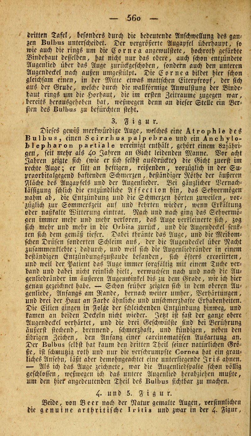 dritten tafer, fcefonbcrS burd) bie bebeutenbe smfdjweffung bc$ gan- gen Bulbus unterfdjeibet. Der »ergrßfjerte Augapfel iikri^aupt, fo wie aud) bte ring^ um hu Cornea angemutete, (jocfyrot^ gefärbte 25inbef>aut beffetben, f>at nid)t nur baö obere, aud) fd>on ent$ünbete Sfugenlieb über ha$ #nge sitrücfgefdwben, fonbern aud) ben unteren 2(ugenbecfef nad) außen umgeftüfpt. Die Cornea bi(bet fuer fd)on greidjfam einen, in ber Witte ttmai mattfdjen (Eiterpfropf, ber ftd> au3 ber @rube, wetcfyc burd) bte watfförmige Stnwufjtung ber 23inbe-- fjtut ringS um bte £orf>aut, bte im erjlen ^ätxaumc sugegen war, tfereitS f>erau3gef)oben f)at, weswegen benn an biefer ©teffe ein 23er= flen be$ Bulbus au befürchten tfefrt. 3. 3 i g u r. £)iefeS gewiß merFwürbige SOtge, n)efd)e§ eine Atrophie be$ Bulbus, einen Scirrhus P.aJp ebrae unb ein Anchylo- blepharon partiale »ereinigt entfmtt, gehört einem %2\<x\)xv gen, feit mefjr af$ 4° Sauren an ®i$t teibenben 5Kanne. SSor a$t Sauren geigte ftcf? (wie er ftcfy felbjt auSbrücfte) bte @id)t suerjt im rechte SOtge; er litt an heftigen, reißenben, ttorsügticfy in ber ®u* praorbttafgegenb fraftenben ©d)mer3en,.beftänbiger Sftöf^e ber äußeren gfädje be3 ShtgapfeB unb ber Stugcnfteber. Sei gänstidjer Sernadv- läfjigung fct>ltc§ bte entsünbticfye Stffection fnn, ha$ ©ebbermogen tial)m ab, bie dntjiinbung unb bie ©dmteraen fürten suweifen, »or- 'güglicfy jur ©ommer^eit auf unb festen wteber, wenn (Erwartung ober naßMte Sßttterung eintrat %laü) unb nad) ging ha$ ©efwermö- cien immer ntetyr unb mefjr »erforen, baS 2ütge »erfleinerte ftd), 50g ftd) me^r unb meftr in bie Orbita juriicf, unb hu Stugenbecfef fenf* len ftd) bem gemäß tiefer. Qafo'i t^ränte htö $uge, unb bie Meibom- fdjen £>rüfen fonberten ©d)tetm au$, berbie 2(ugenbecM über Watyt lufammenfkltt; baburc^, unb weit ftd) bie Sfugenliebränber in einem iejtänbigen <5nt$ünbungg3uflaube befanben, ftd) öfters? ercoriirten, unb weit ber ^attent ha$ 2luge immer forgfätttg mit einem Quäit ver- fcanb unb babet ntd)t reintid) j)ieft, »erwudjfen nad) unb nad) bie 5tu- genliebränber im äußeren SIugenräinM txß gu bem @rabe, wie id) ^ier genau gewidmet fmbe. — ©cfyon früher seigten ftd) in bem oberen 2Iu- gentiebe, anfangs am 9?anbe, fernad) weiter untrer, Verhärtungen, unb bret ber paut an ^arbe ä^ntid)e unb unfd)mersf)afte ^rbabenfjeiten. Sie Milien gingen in ^otge ber fd)teic^enben (nttjünbung hinweg, unb famen an beiben Wedeln nid)t wieber. 3f|t ijt fa|t ber ganse obere Stugenbecfet »erhärtet, unb bie brei @efc^wür|te ft'nb Ui Serü^rung aufjcrjt jled)enbr brennenb, fd^mer^aft, unb h'tnbigen, neben hen übrigen 3eid)en, ben Anfang einer caretnomatöfen 5(u^artung an. Der Bulbus fetbjt i)at faum ben britten X^eit feiner natürlid^en @rß= fe, ijt fc^mu^tg rott; unb nur hu »erfcfyrumpfte Cornea §at ein grau- Itc^e^ STnfe^n, läfjt aber bemo|)ngead)tet eine untertiegenbe 3ri3 af)nen. — WH ic^ ha& 2(uge jeid)nete, war bie 5tugentiebfpafte fd^en »öffig gefc^tolTen, weswegen id) ba$ untere 2tugentieb f)erab^iefjen mu$U, um ben Jief angebeutenben £j>etf beö Bulbus ftct)toar ju machen. 4. unb 5. 5 i g u r. 35eibe, »on 35 cer nad) ber 5f?atur ^maitc 3(ugen, »erftnntic^en bie genuine art|»rttifc^e Iritis unb swar in ber 4- ftiöur,