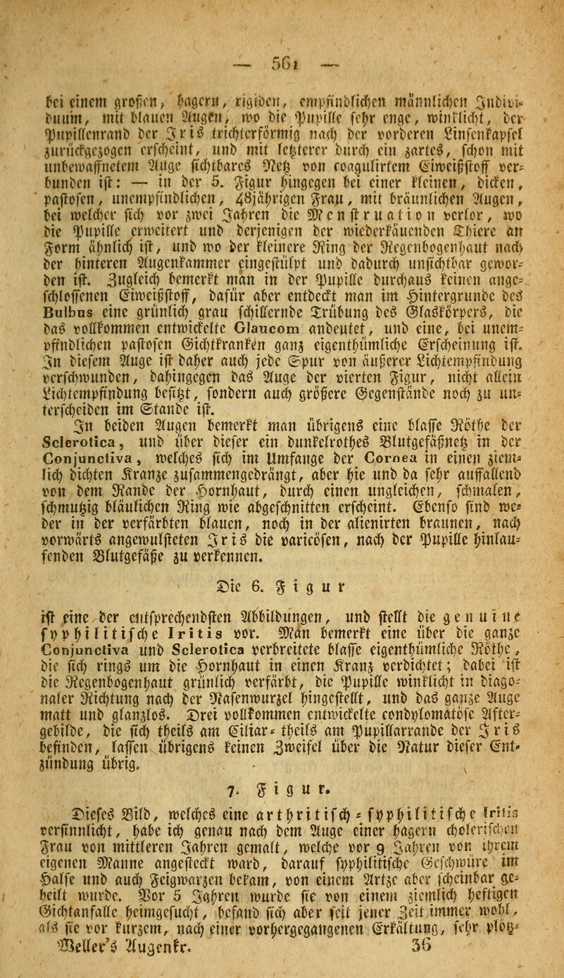 fei einem große«, Magern, reiben, empfinbfid&cn mä'mtfid)en $nbi»i« buum, mit blauen Singen, wo bie *pupifte fef;r enge, winnid)t, ber <)}uptttenranb ber %ri$ trichterförmig nad) bor vorberen SinfenFapfef jurücfgcjogcn erfdjeint, unt mit fetterer burd) ein sarteS, fdjon mit unbewaffnetem SUtgc ftcfytbarcS 9?e£ von coagulirtem ßiweifjjfoff ver-- bunben tft: — in ber 5. gigur hingegen bei einer Meinen, bieten, pnftofen, uncmpftnbftdjen, 48jäf)rigcn grau, mit bräunten Wugcn, Ui mtd)(x ftd) vor swei Sauren bie 2D?cn #r uatio u vertor , wo bie ^upttfe erweitert unb derjenigen ber wieberfäuenben £bicre an gorm tynüä) ift, unb wo ber Heinere 9?ing ber 9?egen6ogen|aut nad> ber {unteren 2UtgenFammer cingefh'tfpt unb baburd) unftcfytbar gcwoiv ben ift. 3ngfcid) bemerkt man in ber ^upitle burcfyauS feinen angc= fcfyloffenen Cnweijjjtojf, bafür aber entbeeft man im £tntergrunbc beS Bulbus eine grüntid) grau fdjitlernbe Xrübung beS ÖtfaSförperS, bie ba& vollkommen entwickelte Glaucom anbukt, unb eine, bei unem- pffnbtidjen paflofen ©icfytfranfen ganj eigentümliche drfdjeimmg tjh 3n t'ufem 2lugc ijt bafjer mü) \cbc ©pur pon äußerer &d)tempfmbung verfdjwunben, balnngegen ta$ 2(uge ber vierten §igur, nicr>t allein &d)tempftnbung beft£t, fonbern auci) größere (Segenftänbe nod) an nm terfcfyctbcn im ©taube ijt. 3n Reiben 5tagen bemerft man übrigens eine Maffe $etl;e ber Sclerotica, unb über tiefer ein bunfelrottyeS 23lutgefäjmeij in ber Conjunctiva, weld)eS ftd) im Umfange ber Cornea in einen siem* Hcfy bieten Äranje jnfammengebrängt, aber tue unb ta fefjr aufaßenb von tem 9?anbe ber |)omf)aut, burd) einen ungleichen, fdmtaten, fd)mu£ig bläulichen $ing wie abgefdjnitten erfc^cint. ©benfo ftnb we* ber in ber verfärbten btauen, nod) in ber afiemrten braunen, nad) »erwarte angewuljteten 3 r i ß bie varieöfen, nad) ber Pupille £tnlau= fenben Slutgefäfe ju »ernennen. Sie 6. % i g u r itf eine ber cntfpredjenbjten 2tbbtlbungen, unb jtetft bie genuine fpp l)Utttfd)e Iritis vor. An bemerkt eine über bie gan(>c Conjunctiva unb Sclerotica perbreitete Hafte eigentümliche -Kon)c, bie ftd) ringS um tu -£>ornf>aut in einen £ranj verbietet; babet ijt bie 3fcgenbogcnl;aut grüntid) verfärbt, tu ^upiftc winFltd)t in btago- nafer 3üicfytung nad) ber 9tafenwursel ^ingeftetrt, unb ta$ gange 2luge matt unb gtanjIoS. £)ret vollkommen entwickelte eonbplomatofc 2lftcr-- gebilbe, bie ftd) tbeiB am biliar * t^ciB am q3upiffarranbe ber ^riS beftnben, raffen übrigens feinen 3weifel über tu Oiatur biefer €nt* jünbung übrig. y 7- ^ i ö u r. DicfeS SB'tib, welches eine art5>rittfc^ ^ f^p^ifittfe^e Iritis rerftnn(id)t, fyaU id) genau nad) bem 5tuge einer fjagern d)ütenfcl)tn grau pon mittleren 3af)ren gemaft, welche »or 9 Saften von it;rcm eigenen -3)?anne angejlecft warb, barauf fpp|)Uttif^c @efd)würe im f>affe unb au^ geigwar$en Mam, pou einem Slrtje aber fc^cinbar ge^ ^eift wnrbe. SSor 5 Sauren würbe ft'e von einem siemlid) heftigen @i(^tanfaEc ^eimgcfud)t, befanb ftd) aber feit jener ßeit immer wtU, afs fü vor fursem, nact) einer port;eraegattgenen drfättuno, febr vlö$* ^eUer^ 'ifu^enfr. 56