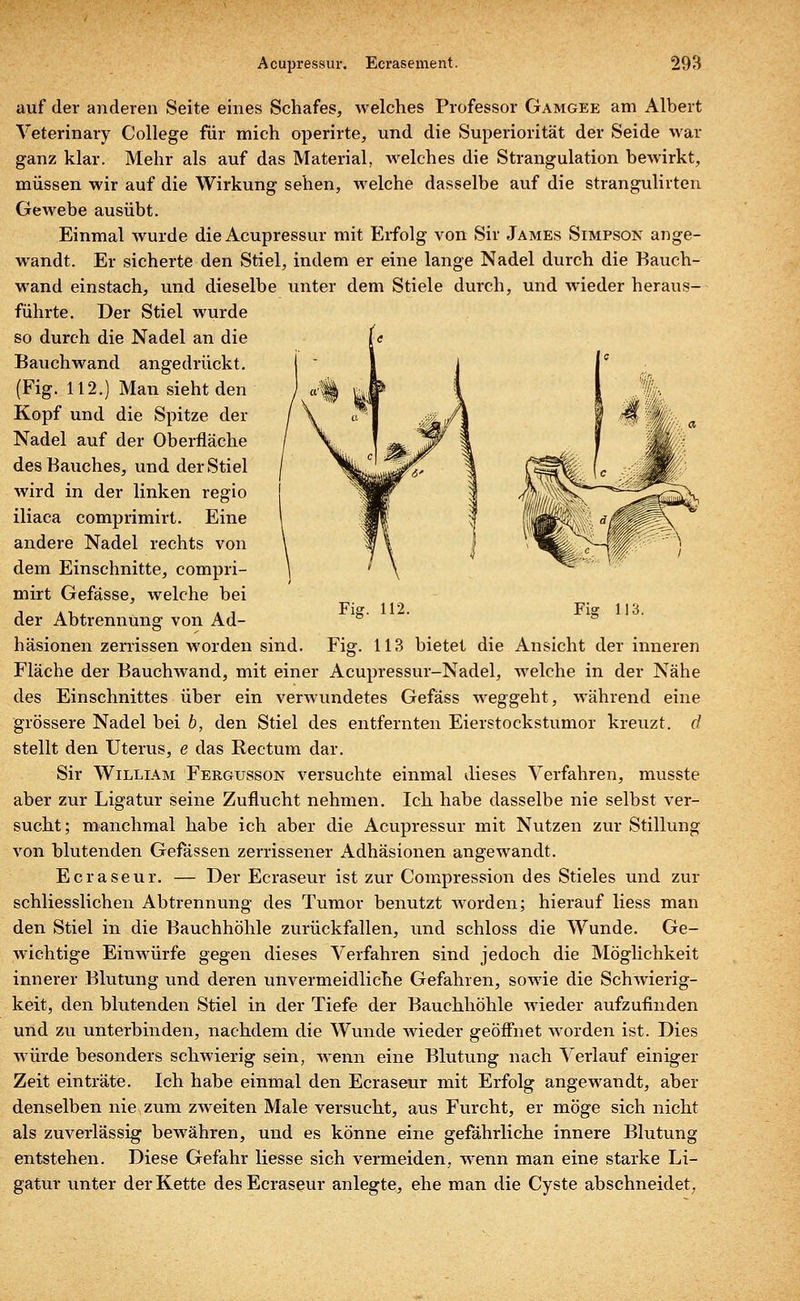 Fig. 112. Fig 113. auf der anderen Seite eines Schafes, Avelches Professor Gamgee am Albert Veterinary College für mich operirte, und die Superiorität der Seide war ganz klar. Mehr als auf das Material, welches die Strangulation bewirkt, müssen wir auf die Wirkung sehen, welche dasselbe auf die strangulirten Gewebe ausübt. Einmal wurde die Acupressur mit Erfolg von Sir James Simpson ange- wandt. Er sicherte den Stiel, indem er eine lange Nadel durch die Bauch- wand einstach, und dieselbe unter dem Stiele durch, und wieder heraus- führte. Der Stiel wurde so durch die Nadel an die Bauchwand angedrückt. (Fig. 112.) Man sieht den Kopf und die Spitze der Nadel auf der Oberfläche des Bauches, und der Stiel wird in der linken regio iliaca comprimirt. Eine andere Nadel rechts von dem Einschnitte, compri- mirt Gefässe, welche bei der Abtrennung von Ad- häsionen zerrissen worden sind. Fläche der Bauchwand, mit einer Acupressur-Nadel, welche in der Nähe des Einschnittes über ein verwundetes Gefäss weggeht, während eine grössere Nadel bei b, den Stiel des entfernten Eierstockstumor kreuzt, d stellt den Uterus, e das Rectum dar. Sir William Fergusson versuchte einmal dieses Verfahren, musste aber zur Ligatur seine Zuflucht nehmen. Ich habe dasselbe nie selbst ver- sucht; manchmal habe ich aber die Acupressur mit Nutzen zur Stillung von blutenden Gefässen zerrissener Adhäsionen angewandt. Ecraseur. — Der Ecraseur ist zur Compression des Stieles und zur schliesslichen Abtrennung des Tumor benutzt worden; hierauf Hess man den Stiel in die Bauchhöhle zurückfallen, und schloss die Wunde. Ge- wichtige Einwürfe gegen dieses Verfahren sind jedoch die Möglichkeit innerer Blutung und deren unvermeidliche Gefahren, sowie die Schwierig- keit, den blutenden Stiel in der Tiefe der Bauchhöhle wieder aufzufinden und zu unterbinden, nachdem die Wunde wieder geöffnet worden ist. Dies würde besonders schwierig sein, wenn eine Blutung nach Verlauf einiger Zeit einträte. Ich habe einmal den Ecraseur mit Erfolg angewandt, aber denselben nie zum zweiten Male versucht, aus Furcht, er möge sich nicht als zuverlässig bewähren, und es könne eine gefährliche innere Blutung entstehen. Diese Gefahr Hesse sich vermeiden, wenn man eine starke Li- gatur unter der Kette des Ecraseur anlegte, ehe man die Cyste abschneidet. Fig. 113 bietet die Ansicht der inneren