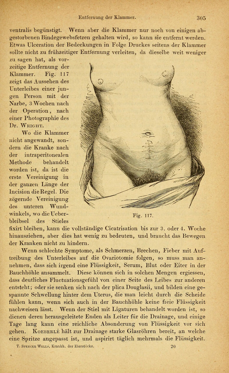 ventralis begünstigt. Wenn aber die Klammer nur noch von einigen ab- gestorbenen Bindegewebsfetzen gehalten wird, so kann sie entfernt werden. Etwas Ulceration der Bedeckungen in Folge Druckes seitens der Klammer sollte nicht zu frühzeitiger Entfernung verleiten, da dieselbe weit weniger zu sagen hat, als vor- zeitige Entfernung der Klammer. Fig. 117 zeigt das Aussehen des Unterleibes einer jun- gen Person mit der Narbe, 3 Wochen nach der Operation, nach einer Photographie des Dr. Wright. Wo die Klammer nicht angewandt, son- dern die Kranke nach der intraperitonealen Methode behandelt worden ist, da ist die erste Vereinigung in der ganzen Länge der Incision die Regel. Die zögernde Vereinigung de« unteren Wund- winkels, wo die Ueber- bleibsel des Stieles fixirt bleiben, kann die vollständige Cicatrisation bis zur 3. oder 4. Woche hinausziehen, aber dies hat wenig zu bedeuten, und braucht das Bewegen der Kranken nicht zu hindern. Wenn schlechte Symptome, als Schmerzen, Brechen, Fieber mit Auf- treibung des Unterleibes auf die Ovariotomie folgen, so muss man an- nehmen, dass sich irgend eine Flüssigkeit, Serum, Blut oder Eiter in der Bauchhöhle ansammelt. Diese können sich in solchen Mengen ergiessen, dass deutliches Fluctuationsgefühl von einer Seite des Leibes zur anderen entsteht; oder sie senken sich nach der plica Douglasii, und bilden eine ge- spannte Schwellung hinter dem Uterus, die man leicht durch die Scheide fühlen kann, wenn sich auch in der Bauchhöhle keine freie Flüssigkeit nachweisen lässt. Wenn der Stiel mit Ligaturen behandelt worden ist, so dienen deren herausgeleitete Enden als Leiter für die Drainage, und einige Tage lang kann eine reichliche Absonderung von Flüssigkeit vor sich gehen. Koeberle hält zur Drainage starke Glasröhren bereit, an welche eine Spritze angepasst ist, und aspirirt täglich mehrmals die Flüssigkeit. T. Spencer Wells, Krankh. der Eierstöcke. 20