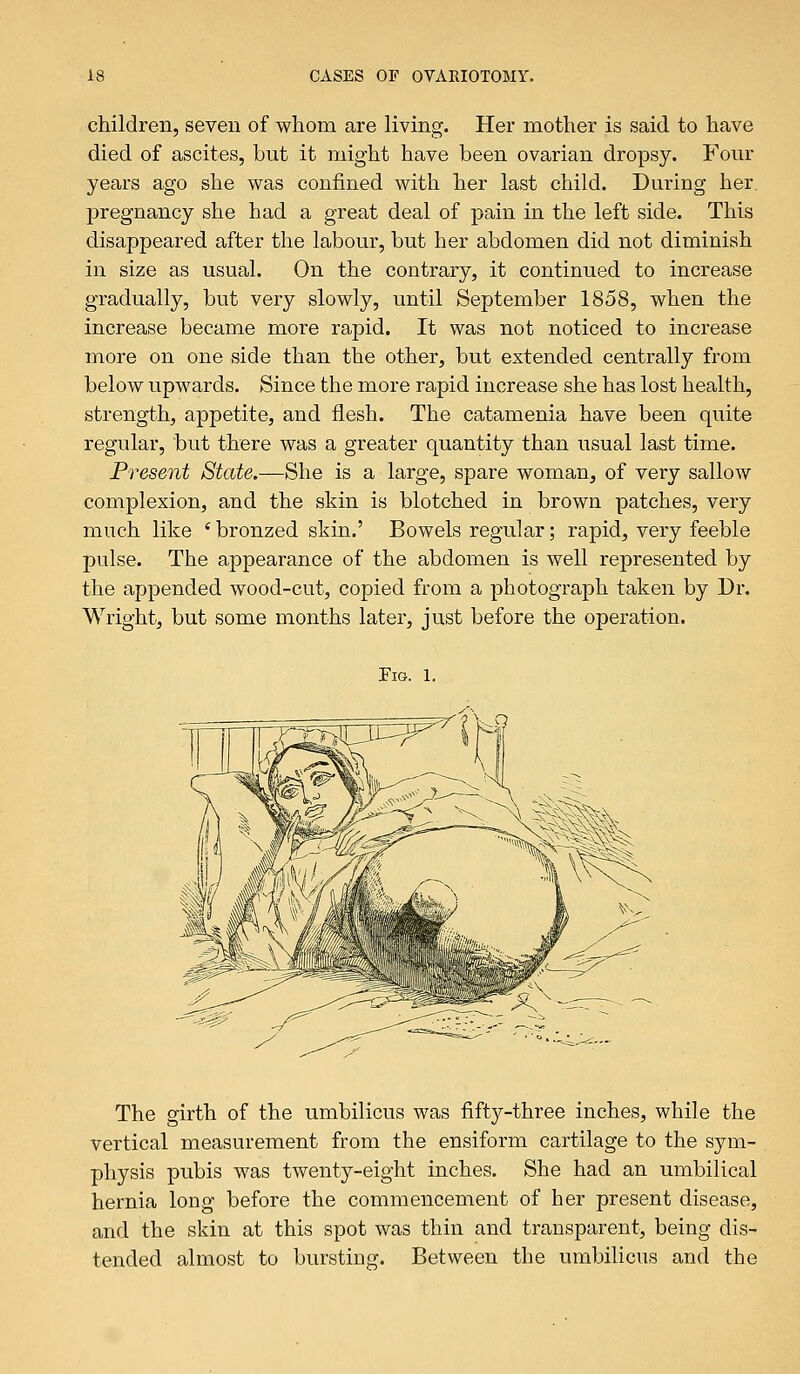 children, seven of whom are living. Her mother is said to have died of ascites, but it might have been ovarian dropsy. Four years ago she was confined with her last child. During her pregnancy she had a great deal of pain in the left side. This disappeared after the labour, but her abdomen did not diminish in size as usual. On the contrary, it continued to increase gradually, but very slowly, until September 1858, when the increase became more rapid. It was not noticed to increase more on one side than the other, but extended centrally from below upwards. Since the more rapid increase she has lost health, strength, appetite, and flesh. The catamenia have been quite regular, but there was a greater quantity than usual last time. Present State.—She is a large, spare woman, of very sallow complexion, and the skin is blotched in brown patches, very much like s bronzed skin.' Bowels regular; rapid, very feeble pulse. The appearance of the abdomen is well represented by the appended wood-cut, copied from a photograph taken by Dr. Wright, but some months later, just before the operation. Fig. l. The girth of the umbilicus was fifty-three inches, while the vertical measurement from the ensiform cartilage to the sym- physis pubis was twenty-eight inches. She had an umbilical hernia long before the commencement of her present disease, and the skin at this spot was thin and transparent, being dis- tended almost to bursting. Between the umbilicus and the
