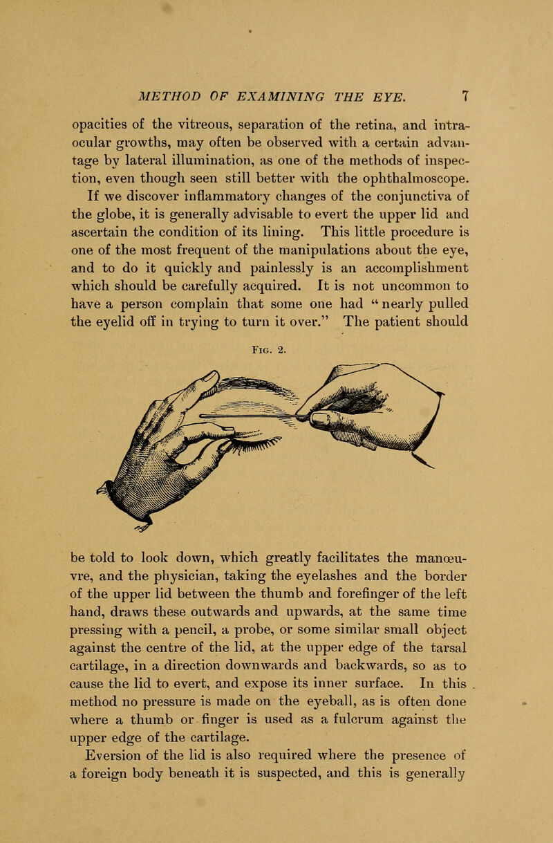 opacities of the vitreous, separation of the retina, and intra- ocular growths, may often be observed with a certain advan- tage by lateral illumination, as one of the methods of inspec- tion, even though seen still better with the ophthalmoscope. If we discover inflammatory changes of the conjunctiva of the globe, it is generally advisable to evert the upper lid and ascertain the condition of its lining. This little procedure is one of the most frequent of the manipulations about the eye, and to do it quickly and painlessly is an accomplishment which should be carefully acquired. It is not uncommon to have a person complain that some one had  nearly pulled the eyelid off in trying to turn it over. The patient should Fig. 2. be told to look down, which greatly facilitates the manoeu- vre, and the physician, taking the eyelashes and the border of the upper lid between the thumb and forefinger of the left hand, draws these outwards and upwards, at the same time pressing with a pencil, a probe, or some similar small object against the centre of the lid, at the upper edge of the tarsal cartilage, in a direction downwards and backwards, so as to cause the lid to evert, and expose its inner surface. In this method no pressure is made on the eyeball, as is often done where a thumb or finger is used as a fulcrum against the upper edge of the cartilage. Eversion of the lid is also required where the presence of a foreign body beneath it is suspected, and this is generally