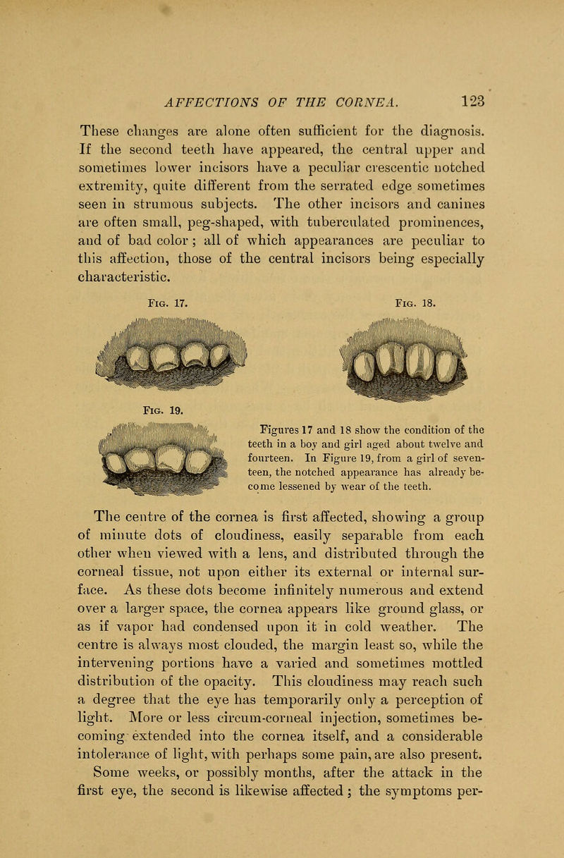 These changes are alone often sufficient for the diagnosis. If the second teeth have appeared, the central upper and sometimes lower incisors have a peculiar crescentic notched extremity, quite different from the serrated edge sometimes seen in strumous subjects. The other incisors and canines are often small, peg-shaped, with tuberculated prominences, and of bad color; all of which appearances are peculiar to this affection, those of the central incisors being especially characteristic. Fig. 17. Fig. 18. Fig. 19. Figures 17 and 18 show the condition of the teeth in a boy and girl aged about twelve and fourteen. In Figure 19, from a girl of seven- teen, the notched appearance has already be- come lessened by wear of the teeth. The centre of the cornea is first affected, showing a group of minute dots of cloudiness, easily separable from each other when viewed with a lens, and distributed through the corneal tissue, not upon either its external or internal sur- face. As these dots become infinitely numerous and extend over a larger space, the cornea appears like ground glass, or as if vapor had condensed upon it in cold weather. The centre is always most clouded, the margin least so, while the intervening portions have a varied and sometimes mottled distribution of the opacity. This cloudiness may reach such a degree that the eye has temporarily only a perception of light. More or less circum-corneal injection, sometimes be- coming extended into the cornea itself, and a considerable intolerance of light, with perhaps some pain, are also present. Some weeks, or possibly months, after the attack in the first eye, the second is likewise affected; the symptoms per-