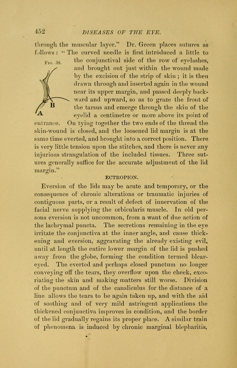 through the muscular layer. Dr. Green places sutures as follows : The curved needle is first introduced a little to Fig 38. ^le conjunctival side of the row of eyelashes, and brought out just within the wound made by the excision of the strip of skin ; it is then drawn through and inserted again in the wound near its upper margin, and passed deeply back- ward and upward, so as to graze the front of the tarsus and emerge through the skin of the -^ eyelid a centimetre or more above its point of entrance. On tying together the two ends of the thread the skin-wound is closed, and the loosened lid margin is at the same time everted, and brought into a correct position. There is very little tension upon the stitches, and there is never any injurious strangulation of the included tissues. Three sut- ures generally suffice for the accurate adjustment of the lid margin. ECTEOPION. Eversion of the lids maybe acute and temporary, or the consequence of chronic alterations or traumatic injuries of contiguous parts, or a result of defect of innervation of the facial nerve supplying the orbicularis muscle. In old per- sons eversion is not uncommon, from a want of due action of the lachrymal puncta. The secretions remaining in the eye irritate the conjunctiva at the inner angle, and cause thick- ening and eversion, aggravating the already existing evil, until at length the entire lower margin of the lid is pushed away from the globe, forming the condition termed blear- eyed. The everted and perhaps closed punctum no longer conveying off the tears, they overflow upon the cheek, exco- riating the skin and making matters still worse. Division of the punctum and of the canaliculus for the distance of a line allows the tears to be again taken up, and with the aid of soothing and of very mild astringent applications the thickened conjunctiva improves in condition, and the border of the lid gradually regains its proper place. A similar train of phenomena is induced by chronic marginal blepharitis,