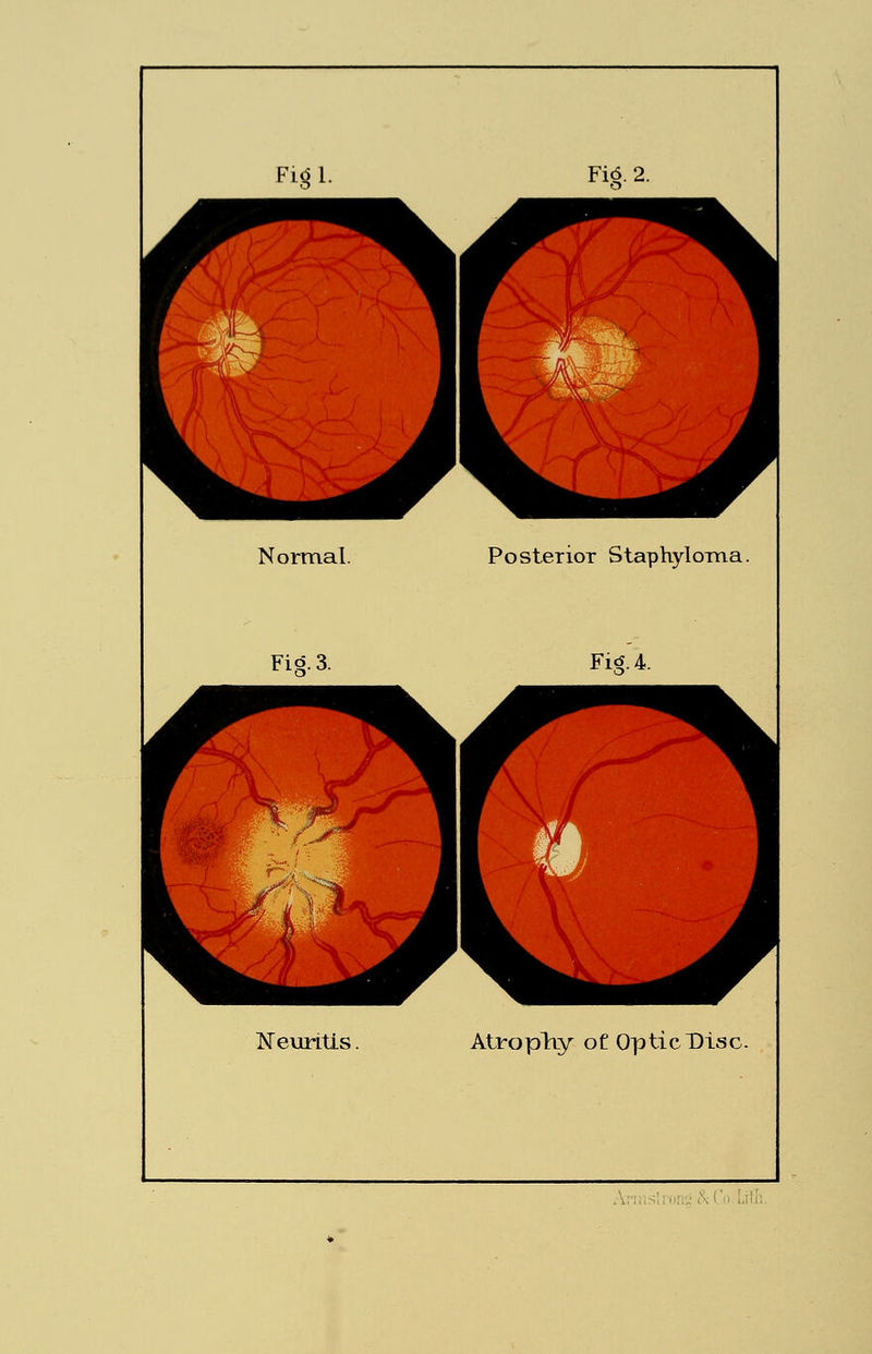 Normal. Posterior Staphyloma. Fitf. 4. Neuritis. Atrophy of Optic Disc.