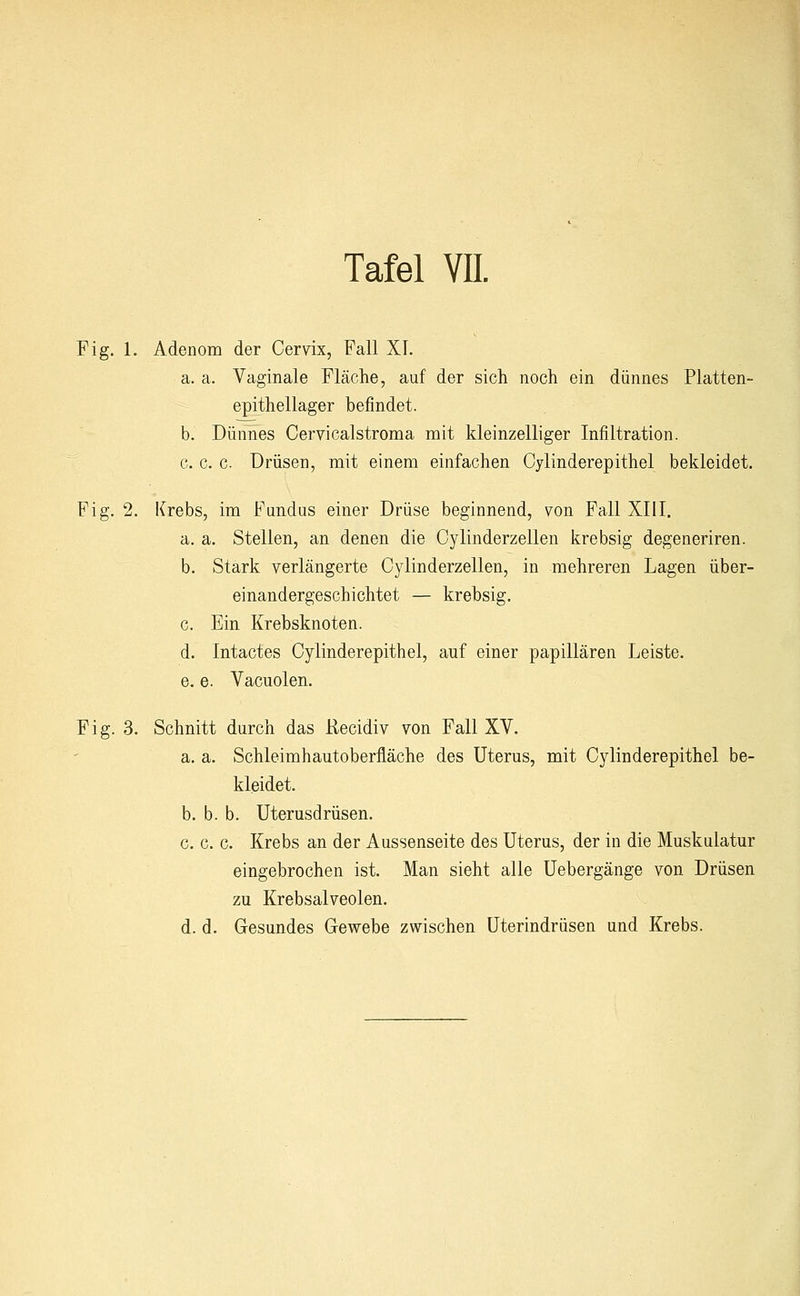 Fig. 1. Adenom der Cervix, Fall XI. a. a. Vaginale Fläche, auf der sich noch ein dünnes Platten- epithellager befindet. b. Dünnes Cervicalstroma mit kleinzelliger Infiltration. c. c. c. Drüsen, mit einem einfachen Cylinderepithel bekleidet. Fig. 2. Krebs, im Fundus einer Drüse beginnend, von Fall XIII. a. a. Stellen, an denen die Cylinderzellen krebsig degeneriren. b. Stark verlängerte Cylinderzellen, in mehreren Lagen über- einandergeschichtet — krebsig. c. Ein Krebsknoten. d. Intactes Cylinderepithel, auf einer papillären Leiste. e. e. Vacuolen. Fig. 3. Schnitt durch das Recidiv von Fall XV. a. a. Schleimhautoberfläche des Uterus, mit Cylinderepithel be- kleidet. b. b. b. Uterusdrüsen. c. c. c. Krebs an der Aussenseite des Uterus, der in die Muskulatur eingebrochen ist. Man sieht alle Uebergänge von Drüsen zu Krebsalveolen. d. d. Gesundes Gewebe zwischen Uterindrüsen und Krebs.