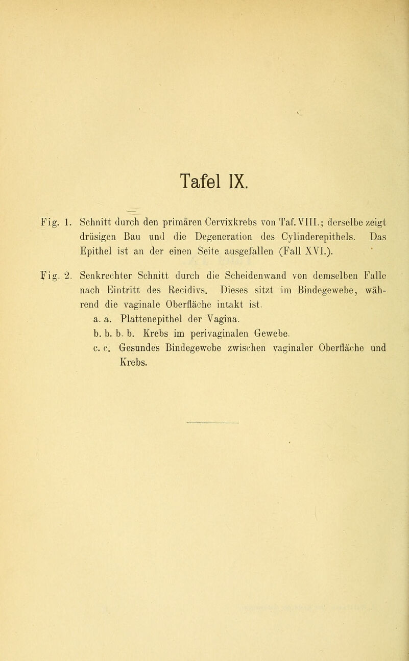 Fig. 1. Schnitt durch den primären Cervixkrebs von Taf.VIIL; derselbe zeigt drüsigen Bau und die Degeneration des Cylinderepithels, Das Epithel ist an der einen Seite ausgefallen (Fall XVI.). JMg- 2. Senkrechter Schnitt durch die Scheidenwand von demselben Falle nach Eintritt des Recidivs. Dieses sitzt im Bindegewebe, wäh- rend die vaginale Oberfläche intakt ist. a. a. Plattenepithel der Vagina. b. b. b. b. Krebs im perivaginalen Gewebe. c. c. Gesundes Bindegewebe zwischen vaginaler Oberfläche und Krebs.