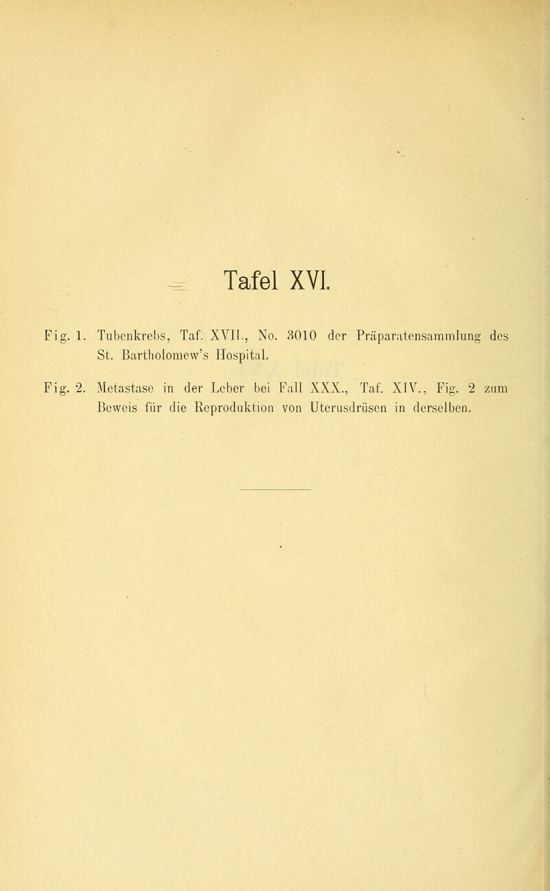 Fig. 1. Tubenkrebs, Taf. XVU., No. 3010 der Präparatensammlung des St. Bartholomew's Hospital. Fig. 2. Metastase in der Leber bei Fall XXX., Tat XIV., Fig. 2 zum Beweis für die Reproduktion von Uterusdrüsen in derselben.