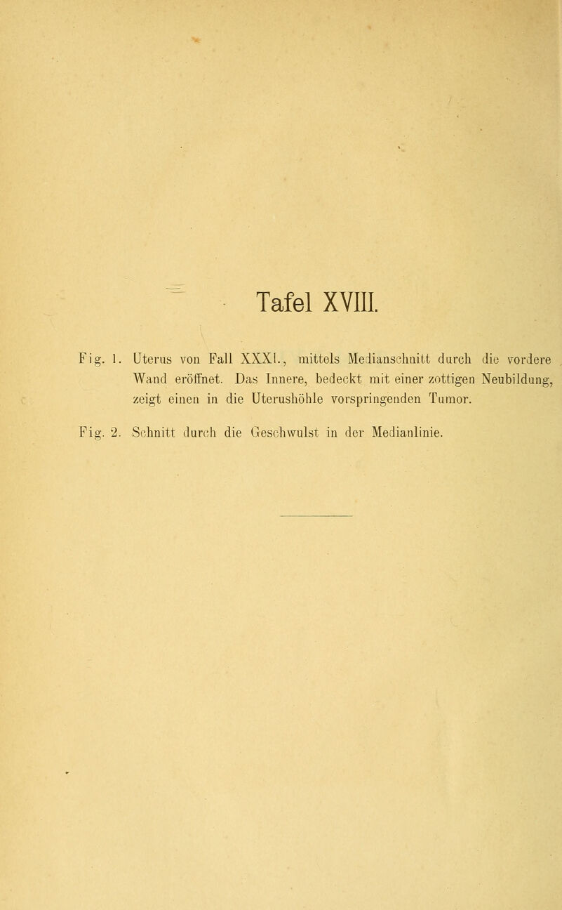 Fig. 1. Uterus von Fall XXXI., mittels Medianschnitt durch die vordere Wand eröffnet. Das Innere, bedeckt mit einer zottigen Neubildung, zeigt einen in die Uterushöhle vorspringenden Tumor. Fig. 2. Schnitt durch die Geschwulst in der Medianlinie.