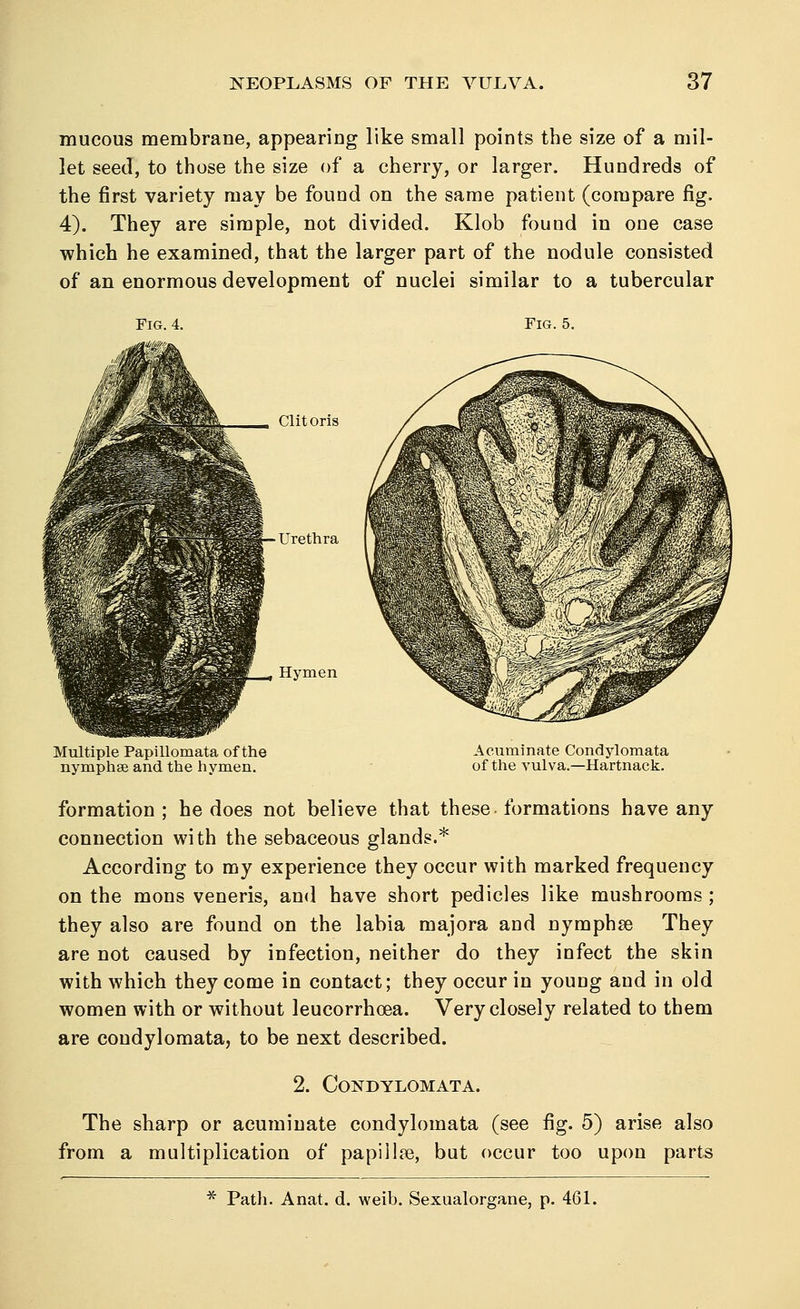 mucous membrane, appearing like small points the size of a mil- let seed, to those the size of a cherry, or larger. Hundreds of the first variety may be found on the same patient (compare fig. 4). They are simple, not divided. Klob found in one case which he examined, that the larger part of the nodule consisted of an enormous development of nuclei similar to a tubercular Fig. 4. Fig. 5. Clitoris Urethra Hymen Multiple Papillomata of the nymphse and the hymen. Acuminate Condylomata of the vulva.—Hartnack. formation ; he does not believe that these formations have any connection with the sebaceous glands.* According to my experience they occur with marked frequency on the mons veneris, and have short pedicles like mushrooms; they also are found on the labia majora and nymphse They are not caused by infection, neither do they infect the skin with which they come in contact; they occur in young and in old women with or without leucorrhoea. Very closely related to them are condylomata, to be next described. 2. Condylomata. The sharp or acuminate condylomata (see fig. 5) arise also from a multiplication of papillae, but occur too upon parts * Path. Anat. d. weib. Sexualorgane, p. 461.