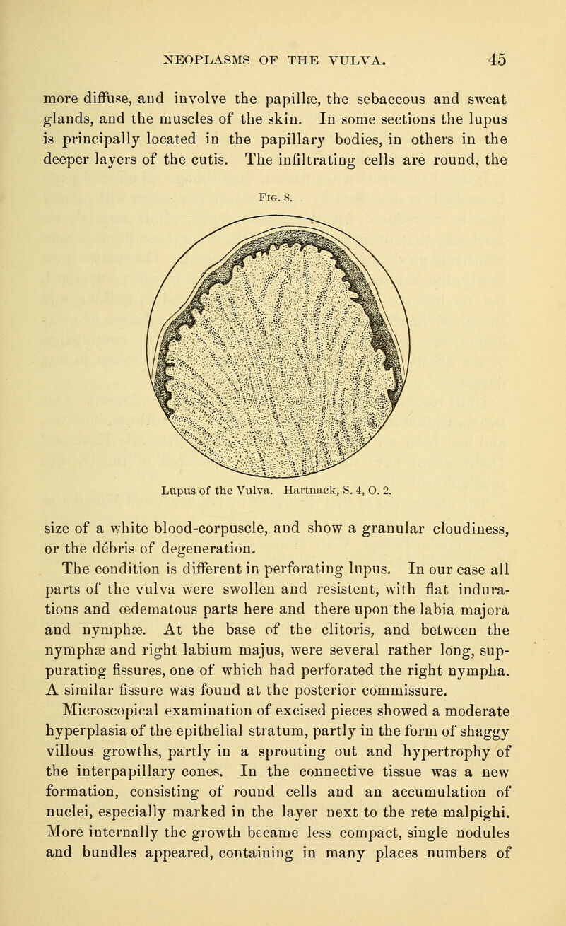 more diffuse, and involve the papillse, the sebaceous and sweat glands, and the muscles of the skin. In some sections the lupus is principally located in the papillary bodies, in others in the deeper layers of the cutis. The infiltrating cells are round, the Fig. 8. Lupus of the Vulva. Hartnack, S. 4, O. 2. size of a white blood-corpuscle, and show a granular cloudiness, or the debris of degeneration. The condition is different in perforating lupus. In our case all parts of the vulva were swollen and resistent, with flat indura- tions and oedematous parts here and there upon the labia majora and nymphse. At the base of the clitoris, and between the nymphaB and right labium majus, were several rather long, sup- purating fissures, one of which had perforated the right nympha. A similar fissure was found at the posterior commissure. Microscopical examination of excised pieces showed a moderate hyperplasia of the epithelial stratum, partly in the form of shaggy villous growths, partly in a sprouting out and hypertrophy of the interpapillary cones. In the connective tissue was a new formation, consisting of round cells and an accumulation of nuclei, especially marked in the layer next to the rete malpighi. More internally the growth became less compact, single nodules and bundles appeared, containing in many places numbers of