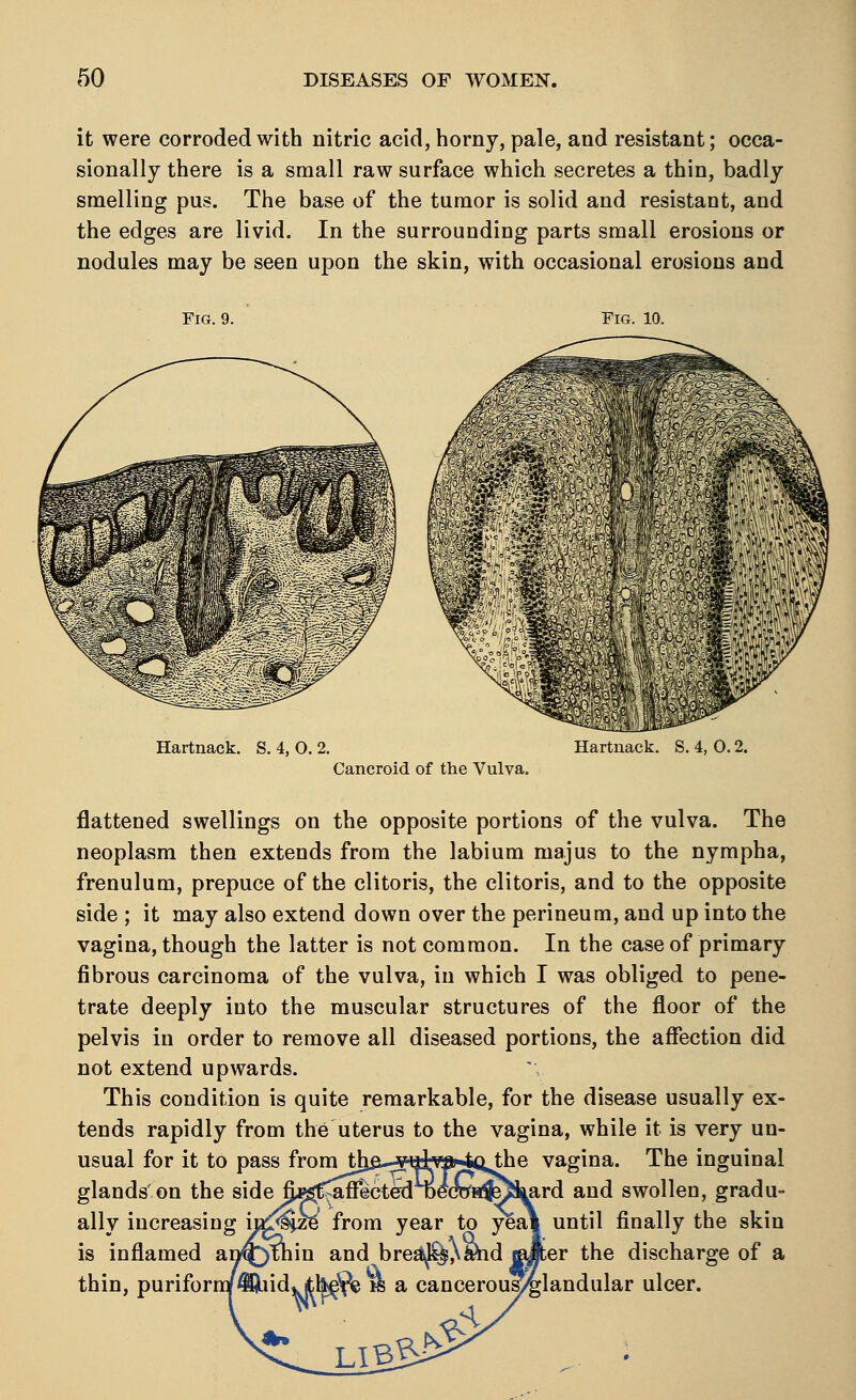 it were corroded with nitric acid, horny, pale, and resistant; occa- sionally there is a small raw surface which secretes a thin, badly smelling pus. The base of the tumor is solid and resistant, and the edges are livid. In the surrounding parts small erosions or nodules may be seen upon the skin, with occasional erosions and Fig. 10. Hartnack. S. 4, O. 2. Hartnack. S. 4, 0.2. Cancroid of the Vulva. flattened swellings on the opposite portions of the vulva. The neoplasm then extends from the labium majus to the nympha, frenulum, prepuce of the clitoris, the clitoris, and to the opposite side ; it may also extend down over the perineum, and up into the vagina, though the latter is not common. In the case of primary fibrous carcinoma of the vulva, in which I was obliged to pene- trate deeply into the muscular structures of the floor of the pelvis in order to remove all diseased portions, the affection did not extend upwards. This condition is quite remarkable, for the disease usually ex- tends rapidly from the uterus to the vagina, while it is very un- usual for it to pass fromitha^ulya^qjhe vagina. The inguinal glands'on the sidep^miGte^roeSiv^^Rrd and swollen, gradu- ally increasing incize from year to yeal until finally the skin is inflamed an^tnin and brea^%^aW «Aer the discharge of a thin, puriforn/433uid,kittoe% w a cancerous/glandular ulcer. A. libbJ