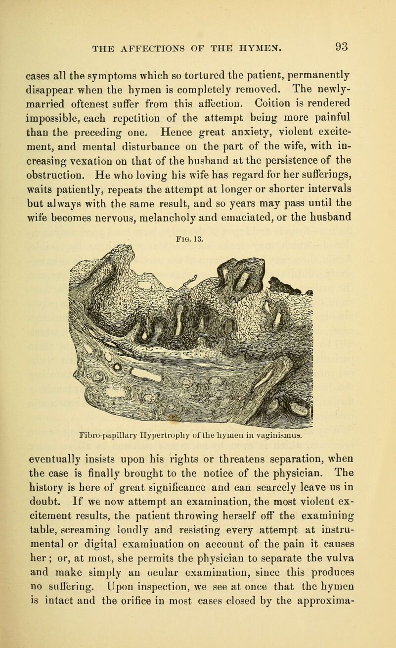 cases all the symptoms which so tortured the patient, permanently disappear when the hymen is completely removed. The newly- married oftenest suffer from this affection. Coition is rendered impossible, each repetition of the attempt being more painful than the preceding one. Hence great anxiety, violent excite- ment, and mental disturbance on the part of the wife, with in- creasing vexation on that of the husband at the persistence of the obstruction. He who loving his wife has regard for her sufferings, waits patiently, repeats the attempt at longer or shorter intervals but always with the same result, and so years may pass until the wife becomes nervous, melancholy and emaciated, or the husband Fig. 13. Fibro-papillary Hypertrophy of the hymen in vaginismus. eventually insists upon his rights or threatens separation, when the case is finally brought to the notice of the physician. The history is here of great significance and can scarcely leave us in doubt. If we now attempt an examination, the most violent ex- citement results, the patient throwing herself off the examining table, screaming loudly and resisting every attempt at instru- mental or digital examination on account of the pain it causes her; or, at most, she permits the physician to separate the vulva and make simply an ocular examination, since this produces no suffering. Upon inspection, we see at once that the hymen is intact and the orifice in most cases closed by the approxima-