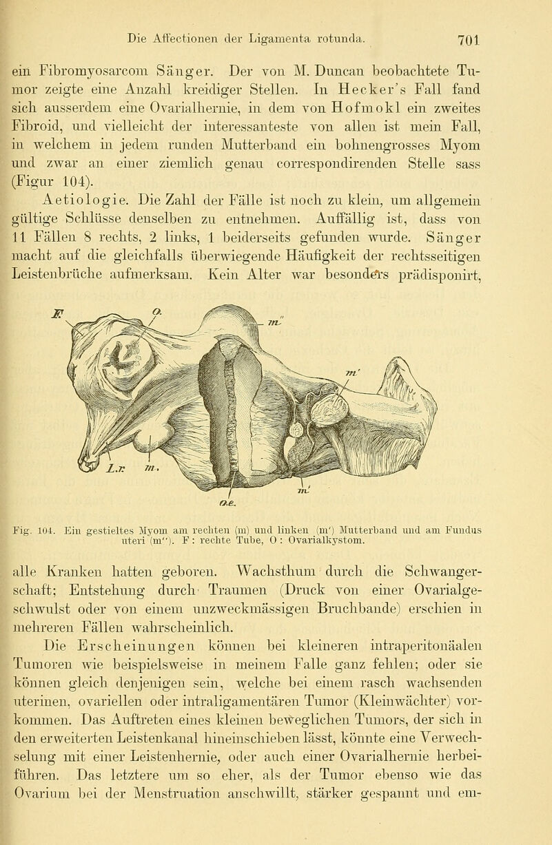 ein Fibromyosarcom Sänger. Der von M. Duncan beobachtete Tu- mor zeigte eine Anzahl kreidiger Stellen. In Hecker's Fall fand sich ausserdem eine Ovarialhernie, in dem von Hofmokl ein zweites Fibroid, und vielleicht der interessanteste von allen ist mein Fall, in welchem in jedem runden Mutterband ein bohnengrosses Myom und zwar an einer ziemlich genau correspondirenden Stelle sass (Figur 104). Aetiologie. Die Zahl der Fälle ist noch zu klein, um allgemein gültige Schlüsse denselben zu entnehmen. Auffällig ist, dass von 11 Fällen 8 rechts, 2 links, 1 beiderseits gefunden wurde. Sänger macht auf die gleichfalls überwiegende Häufigkeit der rechtsseitigen Leistenbrüche aufmerksam. Kein Alter war besonders präclisponirt, Fig. 104. Ein gestieltes Myom am rechten (m) und linken (m') Mutterband und am Fundus uteri (m). F: rechte Tube, 0: Ovarialkystom. alle Kranken hatten geboren. Wachsthum durch die Schwanger- schaft; Entstehung durch' Traumen (Druck von einer Ovarialge- schwulst oder von einem unzweckmässigen Bruchbande) erschien in mehreren Fällen wahrscheinlich. Die Erscheinungen können bei kleineren intraperitonäalen Tumoren wie beispielsweise in meinem Falle ganz fehlen; oder sie können gleich denjenigen sein, welche bei einem rasch wachsenden uterinen, ovariellen oder intraligamentären Tumor (Kleinwächter) vor- kommen. Das Auftreten eines kleinen beweglichen Tumors, der sich in den erweiterten Leistenkanal hineinschieben lässt, könnte eine Verwech- selung mit einer Leistenhernie, oder auch einer Ovarialhernie herbei- führen. Das letztere um so eher, als der Tumor ebenso wie das Ovarium bei der Menstruation anschwillt, stärker gespannt und em-
