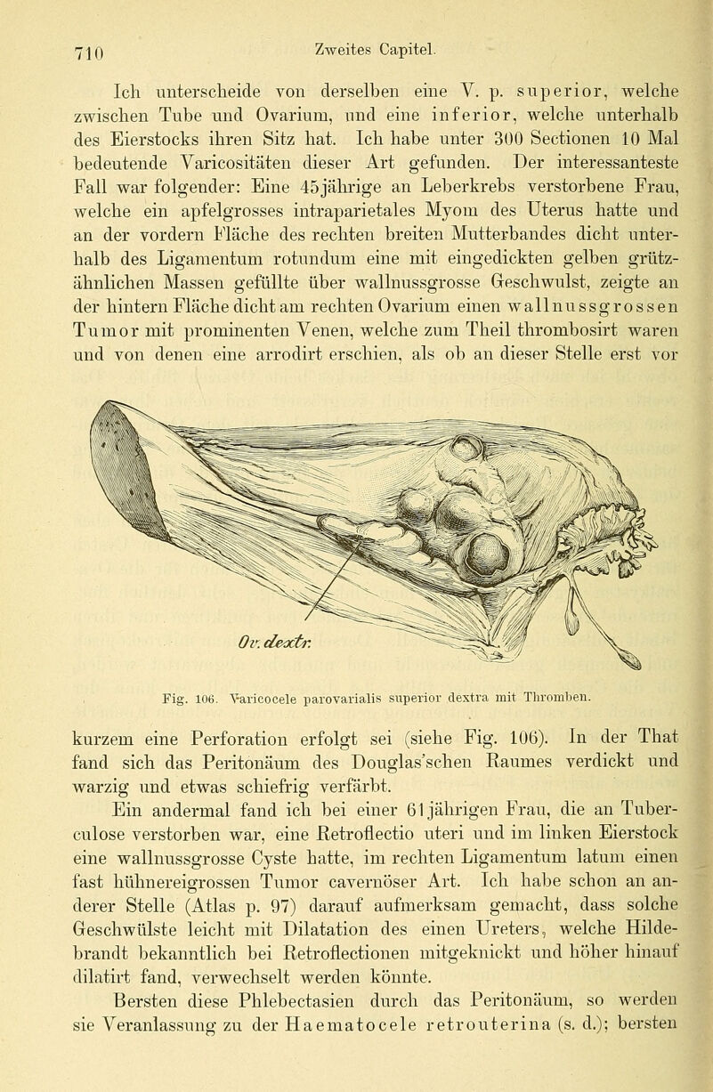 Ich unterscheide von derselben eine V. p. superior, welche zwischen Tube und Ovarium, und eine inferior, welche unterhalb des Eierstocks ihren Sitz hat. Ich habe unter 300 Sectionen 10 Mal bedeutende Varicositäten dieser Art gefunden. Der interessanteste Fall war folgender: Eine 45jährige an Leberkrebs verstorbene Frau, welche ein apfelgrosses intraparietales Myom des Uterus hatte und an der vordem Fläche des rechten breiten Mutterbandes dicht unter- halb des Ligamentum rotnndum eine mit eingedickten gelben grütz- ähnlichen Massen gefüllte über wallnussgrosse Geschwulst, zeigte an der hintern Fläche dicht am rechten Ovarium einen w a 11 n u s s g r o s s e n Tumor mit prominenten Venen, welche zum Theil thrombosirt waren und von denen eine arrodirt erschien, als ob an dieser Stelle erst vor W/y ig' Oi'.deoctr. Fig. 106. Varicocele parovarialis superior dextra mit Thromben. kurzem eine Perforation erfolgt sei (siehe Fig. 106). In der That fand sich das Peritonäum des Douglas'schen Raumes verdickt unc warzig und etwas schiefrig verfärbt. Ein andermal fand ich bei einer 61jährigen Frau, die an Tuber- kulose verstorben war, eine Retrofiectio uteri und im linken Eierstocl eine wallnussgrosse Cyste hatte, im rechten Ligamentum latum einei fast hühnereigrossen Tumor cavernöser Art. Ich habe schon an ar derer Stelle (Atlas p. 97) darauf aufmerksam gemacht, dass solche Geschwülste leicht mit Dilatation des einen Ureters, welche Hilde- brandt bekanntlich bei Retrofiectionen mitgeknickt und höher hinaui dilatirt fand, verwechselt werden könnte. Bersten diese Phlebectasien durch das Peritonäum, so werden sie Veranlassung zu der Haematocele retrouterina (s. d.); berstei