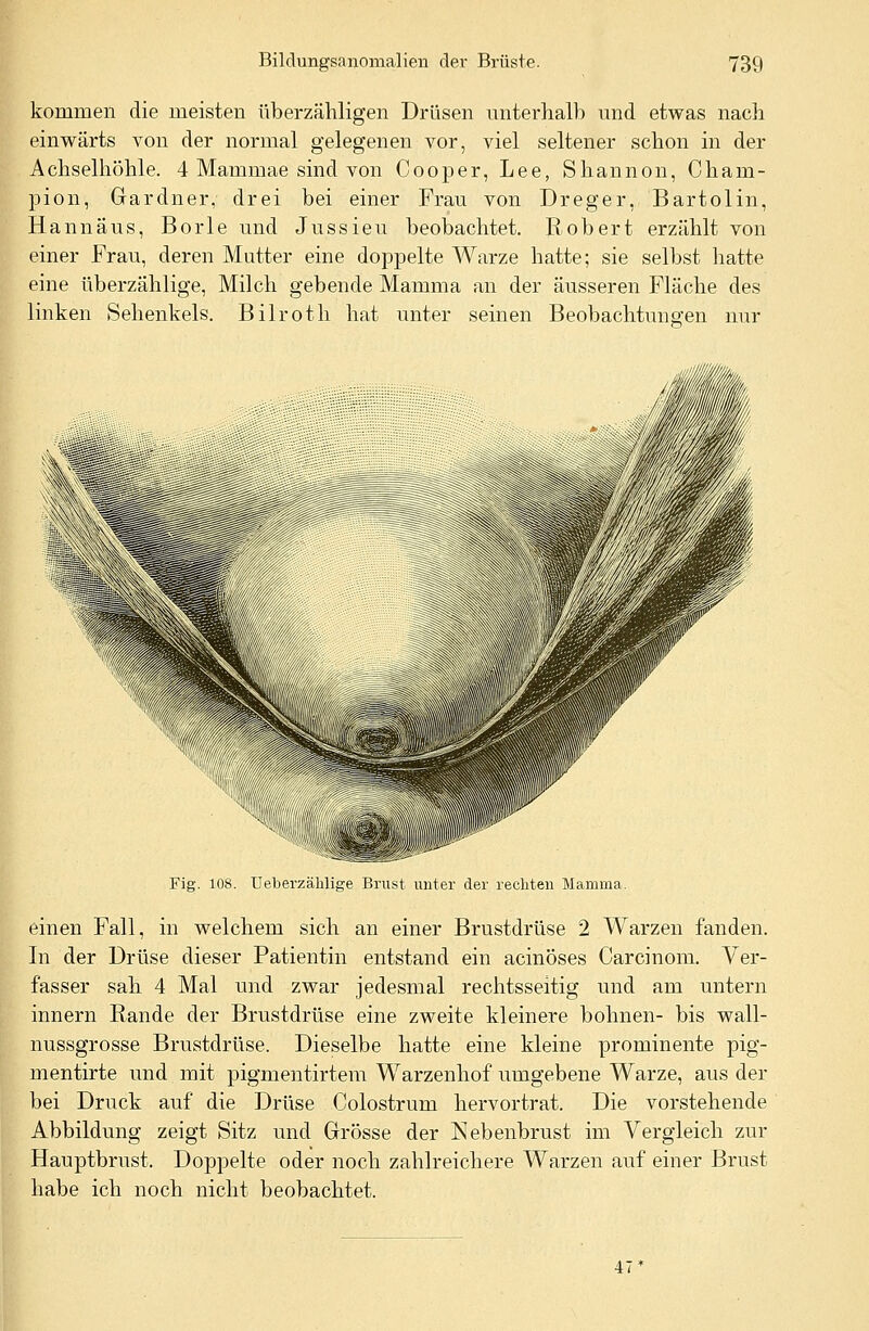 kommen die meisten überzähligen Drüsen unterhalb und etwas nach einwärts von der normal gelegenen vor, viel seltener schon in der Achselhöhle. 4 Mammae sind von Cooper, Lee, Shannon, Cham- pion, Gardner, drei bei einer Frau von Dreger, Bartolin, Hannäus, Borle und Jussieu beobachtet. R,obert erzählt von einer Frau, deren Mutter eine doppelte Warze hatte; sie selbst hatte eine überzählige, Milch gebende Mamma an der äusseren Fläche des linken Sehenkels. Bilroth hat unter seinen Beobachtungen nur Fig. 108. Ueberzählige Brust unter der rechten Mamma. einen Fall, in welchem sich an einer Brustdrüse 2 Warzen fanden. In der Drüse dieser Patientin entstand ein acinöses Carcinom. Ver- fasser sah 4 Mal und zwar jedesmal rechtsseitig und am untern innern Rande der Brustdrüse eine zweite kleinere bohnen- bis wall- nussgrosse Brustdrüse. Dieselbe hatte eine kleine prominente pig- mentirte und mit pigmentirtem Warzenhof umgebene Warze, aus der bei Druck auf die Drüse Colostrum hervortrat. Die vorstehende Abbildung zeigt Sitz und Grösse der Nebenbrust im Vergleich zur Hauptbrust. Doppelte oder noch zahlreichere Warzen auf einer Brust habe ich noch nicht beobachtet. 47