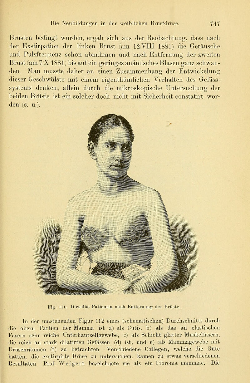 Brüsten bedingt wurden, ergab sich aus der Beobachtung, dass nach der Exstirpation der linken Brust (am 12,VIII 1881) die Geräusche und Pulsfrequenz schon abnahmen und nach Entfernung der zweiten Brust (am 7/X 1881) bis auf ein geringes anämisches Blasen ganz schwan- den. Man musste daher an einen Zusammenhang der Entwicklung dieser Geschwülste mit einem eigenthümlichen Verhalten des Gefäss- systems denken, allein durch die mikroskopische Untersuchung der beiden Brüste ist ein solcher doch nicht mit Sicherheit constatirt wor- den (s. u.). Fig. 111. Dieselbe Patientin nach Entfernung der Brüste. In der umstehenden Figur 112 eines (schematischen) Durchschnitts durch die obern Partien der Mamma ist a) als Cutis, b) als das an elastischen Fasern sehr reiche Unterhautzellgewebe, c) als Schicht glatter Muskelfasern, die reich an stark dilatirten Gefässen (d) ist, und e) als Mammagewebe mit Drüsenräumen (f) zu betrachten. Verschiedene Collegen, welche die Güte hatten, die exstirpirte Drüse zu untersuchen, kamen zu etwas verschiedenen