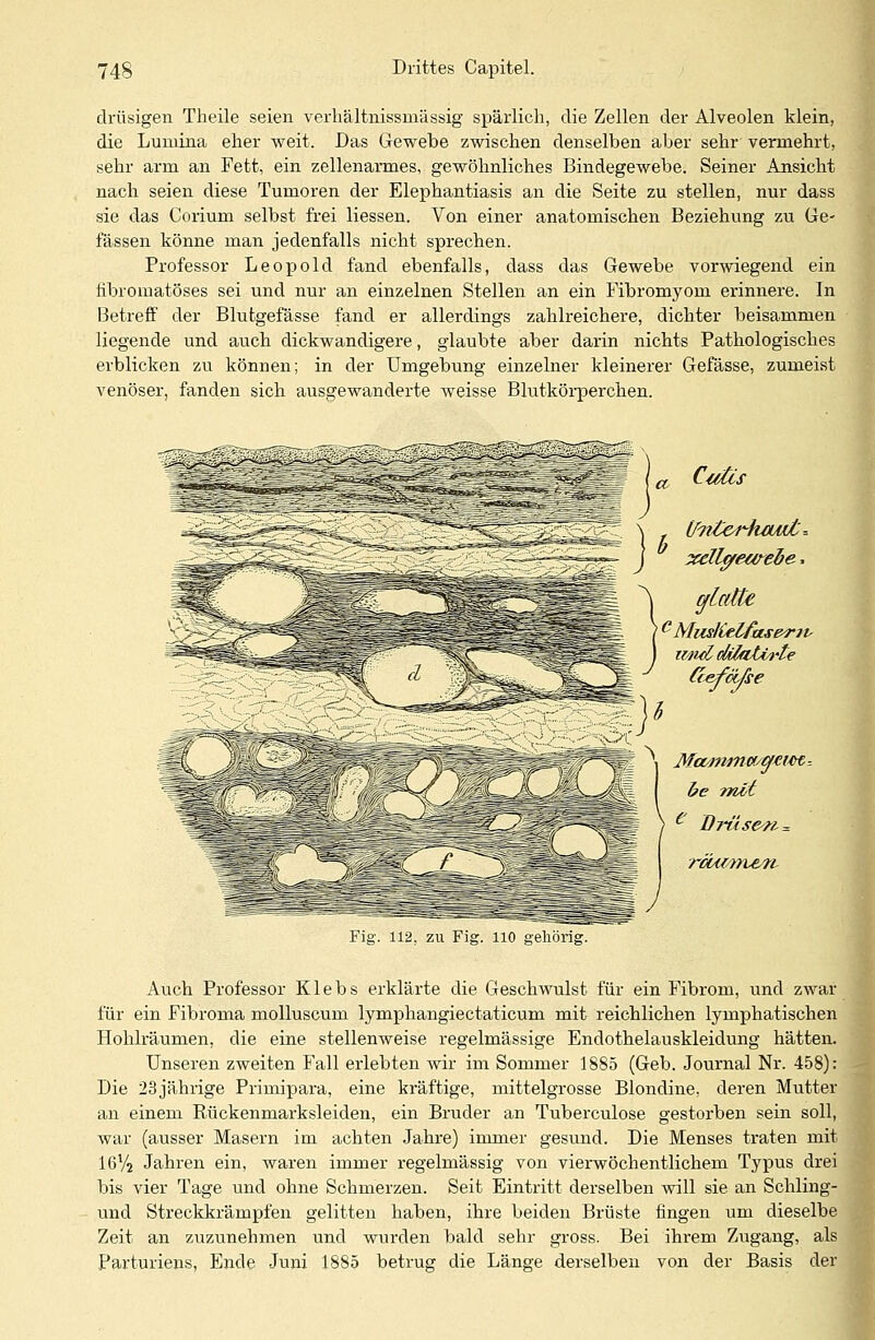 drüsigen Theile seien verhältnissmässig spärlich, die Zellen der Alveolen klein, die Lumina eher weit. Das Gewebe zwischen denselben aber sehr vermehrt, sehr arm an Fett, ein zellenarmes, gewöhnliches Bindegewebe. Seiner Ansicht nach seien diese Tumoren der Elephantiasis an die Seite zu stellen, nur dass sie das Corium selbst frei Hessen. Von einer anatomischen Beziehung zu Ge- fassen könne man jedenfalls nicht sprechen. Professor Leopold fand ebenfalls, dass das Gewebe vorwiegend ein fibromatöses sei und nur an einzelnen Stellen an ein Fibromyom erinnere. In Betreff der Blutgefässe fand er allerdings zahlreichere, dichter beisammen liegende und auch dickwandigere, glaubte aber darin nichts Pathologisches erblicken zu können; in der Umgebung einzelner kleinerer Gefässe, zumeist venöser, fanden sich ausgewanderte weisse Blutkörperchen. Cutis [fttt&riwut'= Zellgewebe, ^ glatte ) c Muslielfaserii- I imuIdilatirte be mit  ~Drüse<ri = rcbwm&n- Auch Professor Klebs erklärte die Geschwulst für ein Fibrom, und zwar für ein Fibroma molluscum lymphangiectaticum mit reichlichen lymphatischen Hohlräumen, die eine stellenweise regelmässige Endothelauskleidung hätten. Unseren zweiten Fall erlebten wir im Sommer 1885 (Geb. Journal Nr. 458): Die 23jährige Primipara, eine kräftige, mittelgrosse Blondine, deren Mutter an einem Rückenmarksleiden, ein Bruder an Tuberculose gestorben sein soll, war (ausser Masern im achten Jahre) immer gesund. Die Menses traten mit I6V2 Jahren ein, waren immer regelmässig von vierwöchentlichem Typus drei bis vier Tage und ohne Schmerzen. Seit Eintritt derselben will sie an Schling- und Streckkrämpfen gelitten haben, ihre beiden Brüste fingen um dieselbe Zeit an zuzunehmen und wurden bald sehr gross. Bei ihrem Zugang, als Parturiens, Ende Juni 1885 betrug die Länge derselben von der Basis der