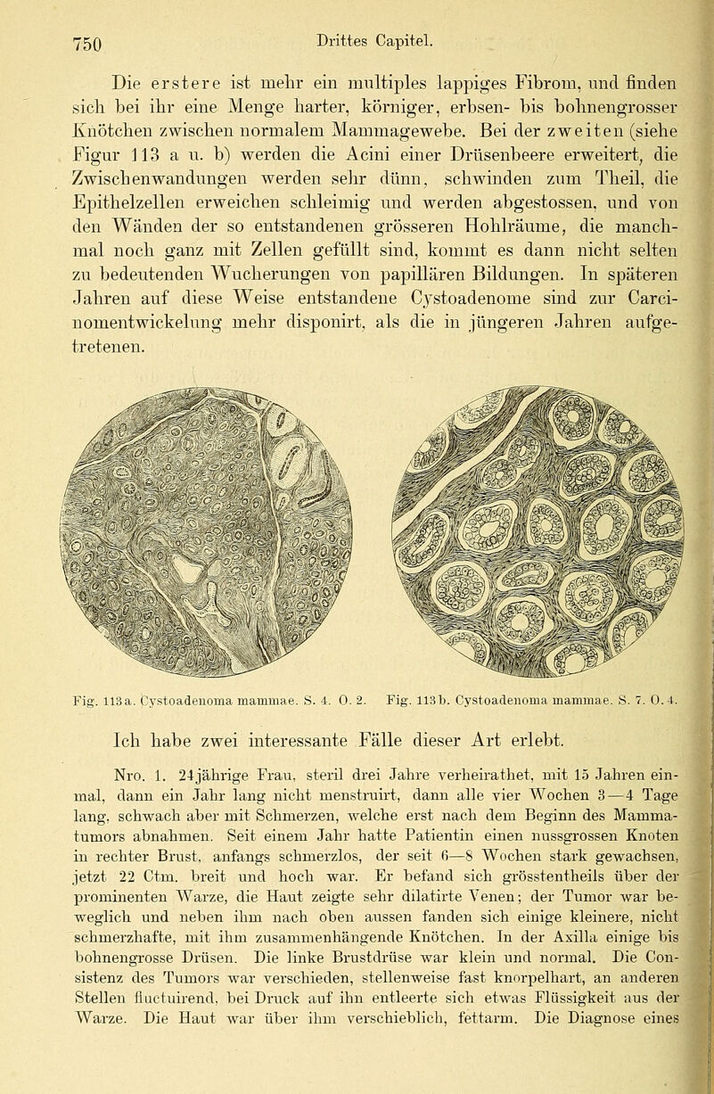 Die erstere ist mehr ein multiples lappiges Fibrom, und finden sich bei ihr eine Menge harter, körniger, erbsen- bis bohnengrosser Knötchen zwischen normalem Mammagewebe. Bei der zweiten (siehe Figur J13 a u. b) werden die Acini einer Drüsenbeere erweitert, die Zwischen Wandungen werden sehr dünn, schwinden zum Theil, die Epithelzellen erweichen schleimig und werden abgestossen, und von den Wanden der so entstandenen grösseren Hohlräume, die manch- mal noch ganz mit Zellen gefüllt sind, kommt es dann nicht selten zu bedeutenden Wucherungen von papillären Bildungen. In späteren Jahren auf diese Weise entstandene Cystoadenome sind zur Carci- nomentwickelung mehr disponirt, als die in jüngeren Jahren aufge- tretenen. Fig. 113a. Cystoadeuoma mammae. S. 4. 0. 2. Fig. 113b. Cystoadenoma mammae. S. 7. 0.4. Ich habe zwei interessante Fälle dieser Art erlebt. Nro. 1. 24 jährige Frau, steril drei Jahre verheirathet, mit 15 Jahren ein- mal, dann ein Jahr lang nicht menstruirt, dann alle vier Wochen 3—4 Tage lang, schwach aber mit Schmerzen, welche erst nach dem Beginn des Mamrna- tumors abnahmen. Seit einem Jahr hatte Patientin einen nussgrossen Knoten in rechter Brust, anfangs schmerzlos, der seit ß—8 Wochen stark gewachsen, jetzt 22 Ctm. breit und hoch war. Er befand sich grösstenteils über der prominenten Warze, die Haut zeigte sehr dilatirte Venen; der Tumor war be- weglich und neben ihm nach oben aussen fanden sich einige kleinere, nicht schmerzhafte, mit ihm zusammenhängende Knötchen. In der Axilla einige bis bohnengrosse Drüsen. Die linke Brustdrüse war klein und normal. Die Con- sistenz des Tumors war verschieden, stellenweise fast knorpelhart, an anderer Stellen fiuctuirend, bei Druck auf ihn entleerte sich etwas Flüssigkeit aus der Warze. Die Haut war über ihm verschieblich, fettarm. Die Diagnose eines