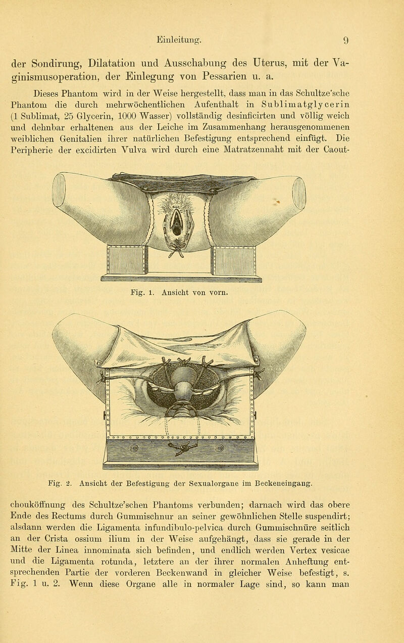 der Sondinmg, Dilatation und Ausschabung des Uterus, mit der Va- ginismusoperation, der Einlegung von Pessarien u. a. Dieses Phantom wird in der Weise hergestellt, dass man in das Schultze'sche Phantom die durch mehrwöchentlichen Aufenthalt in Sublimatglycerin (1 Sublimat, 25 Glycerin, 1000 Wasser) vollständig desinficirten und völlig weich und dehnbar erhaltenen aus der Leiche im Zusammenhang herausgenommenen weiblichen Genitalien ihrer natürlichen Befestigung entsprechend einfügt. Die Peripherie der excidirten Vulva wird durch eine Matratzennaht mit der Caout- Fig. 2. AnsicM der Befestigung der Sexualorgane im Beokeneingang. chouköffnung des Schultze'schen Phantoms verbunden; darnach wird das obere Ende des Eectums durch Gummischnur an seiner gewöhnlichen Stelle suspendirt; alsdann werden die Ligamenta infundibulo-pelvica durch Gummischnüre seitlich an der Crista ossium ilium in der Weise aufgehängt, dass sie gerade in der Mitte der Linea innominata sich befinden, und endlich werden Vertex vesicae und die Ligamenta rotunda, letztere an der ihrer normalen Anheftung ent- sprechenden Partie der vorderen Beckenwand in gleicher Weise befestigt, s. Fig. 1 u. 2. Wenn diese Organe alle in normaler Lage sind, so kann man