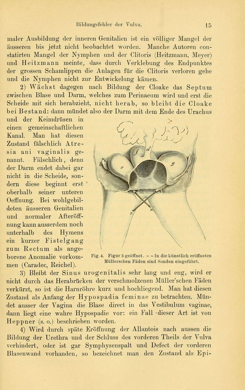 maler Ausbildung der inneren Genitalien ist ein völliger Mangel der äusseren bis jetzt nicht beobachtet worden. Manche Autoren con- statirten Mangel der Nymphen und der Clitoris (Heitzmann, Meyer) und Heitzmann meinte, dass durch Verklebung des Endpunktes der grossen Schamlippen die Anlagen für die Clitoris verloren gehe und die Nymphen nicht zur Entwickelung kämen. 2) Wächst dagegen nach Bildung der Cloake das Septum zwischen Blase und Darm, welches zum Perinaeum wird und erst die Scheide mit sich herabzieht, nicht herab, so bleibt die Cloake bei Bestand: dann mündet also der Darm mit dem Ende des Urachus und der Keimdrüsen in ._ einen gemeinschaftlichen Kanal. Man hat diesen Zustand fälschlich Atre- sia ani vaginalis ge- nannt. Fälschlich , denn der Darm endet dabei gar nicht in die Scheide, son- dern diese beginnt erst oberhalb seiner unteren Oeffnung. Bei wohlgebil- deten äusseren Genitalien und normaler Afteröff- nung kann ausserdem noch unterhalb des Hymens ein kurzer Fistelgang zum Rectum als ange- borene Anomalie vorkom- men (Caradec, Reichel). 3) Bleibt der Sinus urogenitalis sehr lang und eng, wird er nicht durch das Herabrücken der verschmolzenen Müller'schen Fäden verkürzt, so ist die Harnröhre kurz und hochliegend. Man hat diesen Zustand als Anfang der Hypospadia feminae zu betrachten. Mün- det ausser der Vagina die Blase direct in das Vestibulum vaginae, dann liegt eine wahre Hypospadie vor: ein Fall -dieser Art ist von Heppner (s. o.) beschrieben worden. 4) Wird durch späte Eröffnung der AUantois nach aussen die Bildung der Urethra und der Schluss des vorderen Theils der Vulva verhindert, oder ist gar Symphysenspalt und Defect der vorderen Blasenwand vorhanden, so bezeichnet man den Zustand als Epi- Fig. 4. Figur 3 geöffnet, x xln die künstlicli eröffneten Müllerschen Fäden sind Sonden eingeführt.