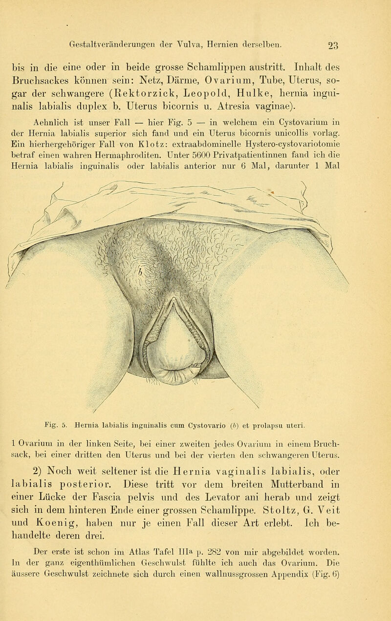 bis in die eine oder in beide grosse Schamlippen austritt. Inhalt des Bruchsackes können sein: Netz, Därme, Ovarium, Tube, Uterus, so- gar der schwangere (Rektorzick, Leopold, Hulke, hernia ingui- nalis labialis duplex b. Uterus bicornis u. Atresia vaginae). Aebnlich ist unser Fall — hier Fig. 5 — in welchem ein Cystovarium in der Hernia labialis superior sich fand und ein Uterus bicornis unicollis vorlag. Ein hierhergehöriger Fall von Klotz: extraabdominelle Hystero-cystovariotomie betraf einen wahren Hermaphroditen. Unter 5600 Privatpatientinnen fand ich die Hernia labialis inguinalis oder labialis anterior nur 6 Mal, darunter 1 Mal Fig. 5. Hernia labialis inguinalis cum Cystovario (h) et prolapsu uteri. 1 Ovarium in der linken Seite, bei einer zweiten jedes Ovarium in einem Bruch- sack, bei einer dritten den Uterus und bei der vierten den schwangeren Uterus. 2) Noch weit seltener ist die Hernia vaginalis labialis, oder labialis posterior. Diese tritt vor dem breiten Mutterband in einer Lücke der Fascia pelvis und des Levator ani herab und zeigt sich in dem hinteren Ende einer grossen Schamlippe. Stoltz, G. Veit und Koenig, haben nur je einen Fall dieser Art erlebt. Ich be- handelte deren drei. Der erste ist schon im Atlas Tafel Illa p. 282 von mir abgebildet worden. In der ganz eigenthümlichen Geschwulst fühlte ich auch das Ovarium. Die äussere Geschwulst zeichnete sich durch einen wallnussgrossen Appendix (Fig. 6)