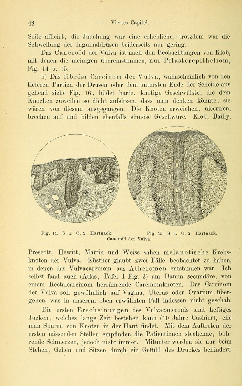 Seite afficirt, die Jaucliung war eine erhebliche, trotzdem war die SchweUung der Inguinaldrüsen beiderseits nur gering. Das Cancroi'd der Vulva ist nach den Beobachtungen von Klob, mit denen die meinigen übereinstimmen, nur Pflasterepitheliom, Fig. 14 u. 15. b) Das fibröse Carcinom der Vulva, wahrscheinlich von den tieferen Partien der Drüsen oder dem untersten Ende der Scheide aus gehend siehe Fig. 16, bildet harte, knotige Geschwülste, die dem Knochen zuweilen so dicht aufsitzen, dass man denken könnte, sie wären von diesem ausgegangen. Die Knoten erweichen, ulceriren, brechen auf und bilden ebenfalls sinuöse Geschwüre. Klob, Bailly, Fig. 14. S. 4. 0. 2. Hartnack. Fig. 15. S. 4. 0. 2. Hartnack. Cancroi'd der Vulva. Frescott, Hewitt, Martin und Weiss sahen melanotische Krebs- knoten der Vulva. Küstner glaubt zwei Fälle beobachtet zu haben, in denen das Vulvacarcinom aus Atheromen entstanden war. Ich selbst fand auch (Atlas, Tafel I Fig. 3) am Damm secundäre, von einem Rectalcarcinom herrührende Carcinomknoten. Das Carcinom der Vulva soll gewöhnlich auf Vagina, Uterus oder Ovarium über- gehen, was in unserem oben erwähnten Fall indessen nicht geschah. Die ersten Erscheinungen des Vulvacancro'ids sind heftiges Jucken, welches lange Zeit bestehen kann (10 Jahre Cushier), ehe man Spuren von Knoten in der Haut findet. Mit dem Auftreten der ersten nässenden Stellen empfinden die Patientinnen stechende, boh- rende Schmerzen, jedoch nicht immer. Mitunter werden sie nur beim Stehen, Gehen und Sitzen durch ein Gefühl des Druckes behindert.