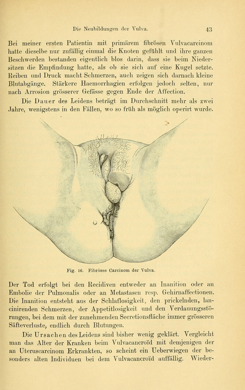 Bei meiner ersten Patientin mit primärem fibrösen Vulvacarcinom hatte dieselbe nur zufällig einmal die Knoten gefühlt und ihre ganzen Beschwerden bestanden eigentlich blos darin, dass sie beim Nieder- sitzen die Empfindung hatte, als ob sie sich auf eine Kugel setzte. Reiben und Druck macht Schmerzen, auch zeigen sich darnach kleine Blutabgänge. Stärkere Haemorrhagien erfolgen jedoch selten, nur nach Arrosion grösserer Gefässe gegen Ende der Affection. Die Dauer des Leidens beträgt im Durchschnitt mehr als zwei Jahre, wenigstens in den FäUen, wo so früh als möglich operirt wurde. Fig. 16. Fibröses Carcinom der Vulva. Der Tod erfolgt bei den Recidiven entweder an Inanition oder an Embolie der Pulmonalis oder an Metastasen resp. Gehirnaffectionen. Die Inanition entsteht aus der Schlaflosigkeit, den prickelnden, lan- cinirenden Schmerzen, der Appetitlosigkeit und den Verdauungsstö- rungen, bei dem mit der zunehmenden Secretionsfläche immer grösseren Säfteverluste, endlich durch Blutungen. Die Ursachen des Leidens sind bisher wenig geklärt. Vergleicht man das Alter der Kranken beim Vulvacancroi'd mit demjenigen der an üteruscarcinom Erkrankten, so scheint ein Ueberwiegen der be- sonders alten Individuen bei dem Vulvacancroid auffällig. Wieder-