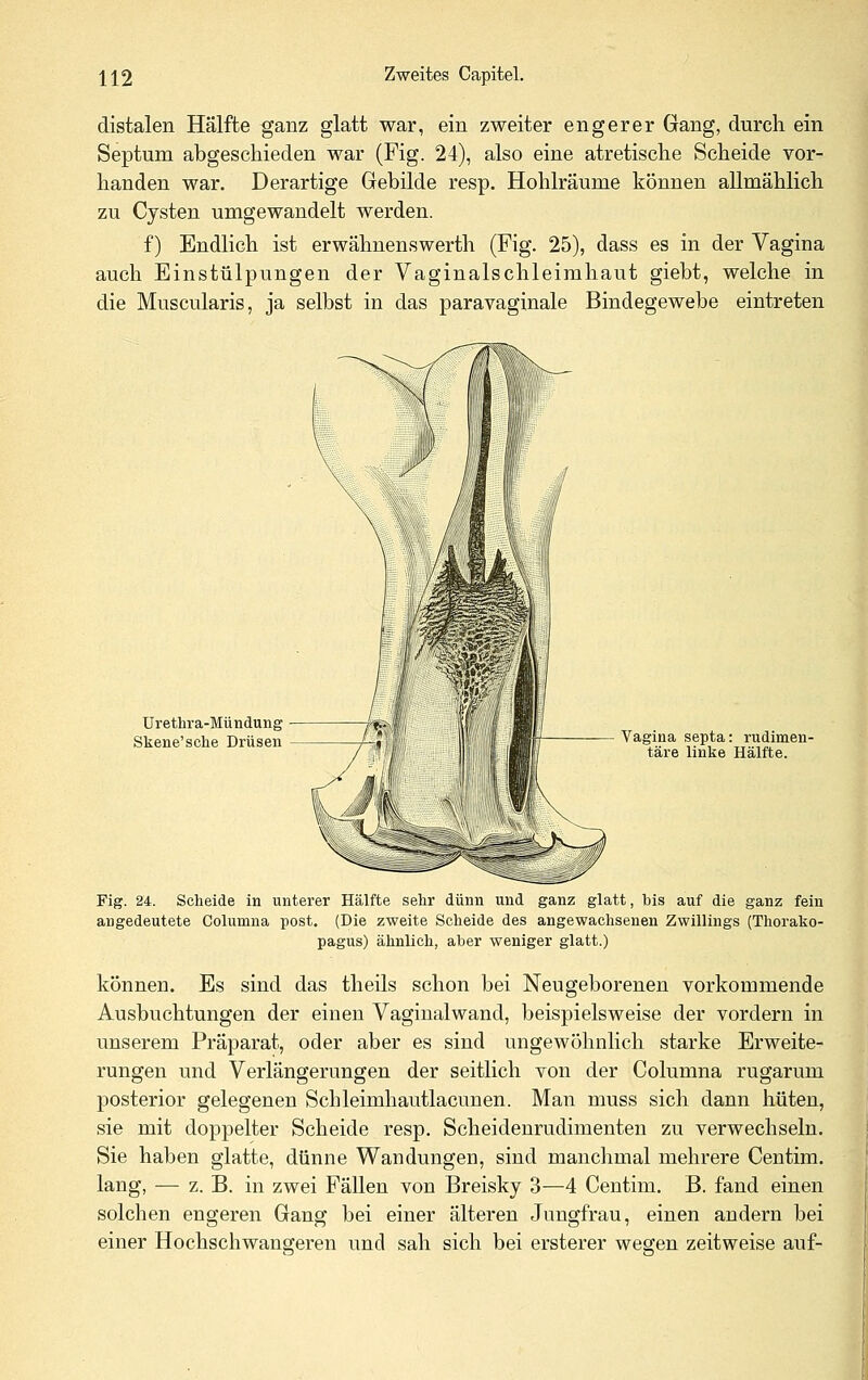 distalen Hälfte ganz glatt war, ein zweiter engerer Gang, durch ein Septum abgeschieden war (Fig. 24), also eine atretische Scheide vor- handen war. Derartige Gebilde resp. Hohlräume können allmählich zu Cysten umgewandelt werden. f) Endlich ist erwähnenswerth (Fig. 25), dass es in der Vagina auch Einstülpungen der Vaginalschleirahaut giebt, welche in die Muscularis, ja selbst in das paravaginale Bindegewebe eintreten Ürethra-Mündung Skene'sche Drüsen Vagina septa: rudimen- täre linke Hälfte. Fig. 24. Scheide in unterer Hälfte sehr dünn und ganz glatt, bis auf die ganz fein angedeutete Columna post. (Die zweite Scheide des angewachsenen Zwillings (Thorako- pagus) ähnlich, aber weniger glatt.) können. Es sind das theils schon bei Neugeborenen vorkommende Ausbuchtungen der einen Vaginalwand, beispielsweise der vordem in unserem Präparat, oder aber es sind ungewöhnlich starke Erweite- rungen und Verlängerungen der seitlich von der Columna rugarum posterior gelegenen Schleimhautlacunen. Man muss sich dann hüten, sie mit doppelter Scheide resp. Scheidenrudimenten zu verwechseln. Sie haben glatte, dünne Wandungen, sind manchmal mehrere Centim. lang, — z. B. in zwei Fällen von Breisky 3—4 Centim. B. fand einen solchen engeren Gang bei einer älteren Jungfrau, einen andern bei einer Hochschwangeren und sah sich bei ersterer wegen zeitweise auf-