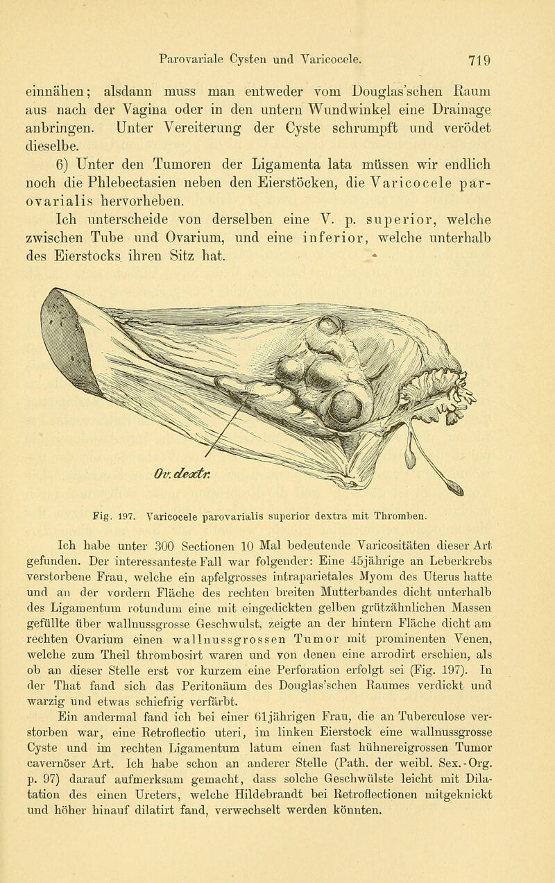 einnähen; alsdann muss man entweder vom Douglas'schen Raum aus nach der Vagina oder in den untern Wundwinkel eine Drainage anbringen. Unter Vereiterung der Cyste schrumpft und verödet dieselbe. 6) Unter den Tumoren der Ligamenta lata müssen wir endlich noch die Phlebectasien neben den Eierstöcken, die Varicocele par- ovarialis hervorheben. Ich unterscheide von derselben eine V. p. superior, welche zwischen Tube und Ovarium, und eine inferior, welche unterhalb des Eierstocks ihren Sitz hat. Ov.deoCtr. Fig. 197. Varicocele parovarialis superior dextra mit Thromben. Ich habe unter 300 Sectionen 10 Mal bedeutende Varicositäten dieser Art gefunden. Der interessanteste Fall war folgender: Eine 45jährige an Leberkrebs verstorbene Frau, welche ein apfelgrosses intraparietales Myom des Uterus hatte und an der vordem Fläche des rechten breiten Mutterbandes dicht unterhalb des Ligamentum rotundum eine mit eingedickten gelben grützähnlichen Massen gefüllte über wallnussgrosse Geschwulst, zeigte an der hintern Fläche dicht am rechten Ovarium einen wallnussgrossen Tumor mit prominenten Venen, welche zum Theil thrombosirt waren und von denen eine arrodirt erschien, als ob an dieser Stelle erst vor kurzem eine Perforation erfolgt sei (Fig. 197). In der That fand sich das Peritonäum des Douglas'schen Raumes verdickt und warzig und etwas schiefrig verfärbt. Ein andermal fand ich bei einer 61jährigen Frau, die an Tuberculose ver- storben war, eine Retroflectio uteri, im linken Eierstock eine wallnussgrosse Cyste und im rechten Ligamentum latum einen fast hühnereigrossen Tumor cavernöser Art. Ich habe schon an anderer Stelle (Path. der weibl. Sex.-Org. p. 97) darauf aufmerksam gemacht, dass solche Geschwülste leicht mit Dila- tation des einen Ureters, welche Hildebrandt bei Retroflectionen mitgeknickt und höher hinauf dilatirt fand, verwechselt werden könnten.