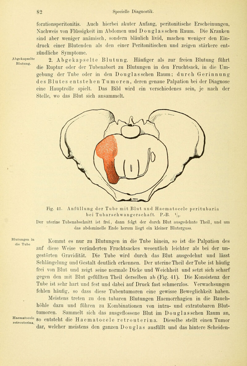 forationsperitonitis. Auch hierbei akuter Anfang, peritonitische Erscheinungen, Nachweis von Flüssigkeit im Abdomen und Douglas sehen Raum. Die Kranken sind aber weniger anämisch, sondern bläulich livid, machen weniger den Ein- druck einer Blutenden als den einer Peritonitischen und zeigen stärkere ent- zündliche Symptome. Abgekapselte 2. Abgekapselte Blutung. Häufiger als zur freien Blutimg führt Blutung. die Ruptur oder der Tubenabort zu Blutungen in den Eruchtsack, in die Um- gebung der Tube oder in den Douglas sehen Raum; durch Gerinnung des Blutes entstehen Tumoren, deren genaue Palpation bei der Diagnose eine Hauptrolle spielt. Das Bild wird ein verschiedenes sein, je nach, der Stelle, wo das Blut sich ansammelt. Fig. 41. Anfüllung der Tube mit Blut und Haematocele peritubaria bei Tubarschwangerschaft. P.-B. 4/3. Der uterine Tubenabscbnitt ist frei, dann folgt der durch Blut ausgedebnte Tbeil, und um das abdominelle Ende herum hegt ein kleiner Bluterguss. Blutungen m Kommt es nur zu Blutungen in die Tube hinein, so ist die Palpation des die Tube b ' L auf diese Weise veränderten Fruchtsackes wesentlich leichter als bei der un- gestörten Gravidität. Die Tube wird durch das Blut ausgedehnt und lässt Schlängelung und Gestalt deutlich erkennen. Der uterine Theil der Tube ist häufig frei von Blut und zeigt seine normale Dicke und Weichheit und setzt sich scharf gegen den mit Blut gefüllten Theil derselben ab (Fig. 41). Die Konsistenz der Tube ist sehr hart und fest und dabei auf Druck fast schmerzlos. Verwachsungen fehlen häufig, so dass diese Tubentumoren eine gewisse Beweglichkeit haben. Meistens treten zu den tubaren Blutungen Haemorrhagien in die Bauch- höhle dazu und führen zu Kombinationen von intra- und extratubaren Blut- tumoren. Sammelt sieb das ausgeflossene Blut im Douglasschen Raum an, fetruterina so entstellt die Haematocele retro uteri na. Dieselbe stellt einen Tumor dar, welcher meistens den ganzen Douglas ausfüllt und das hintere Scheiden-