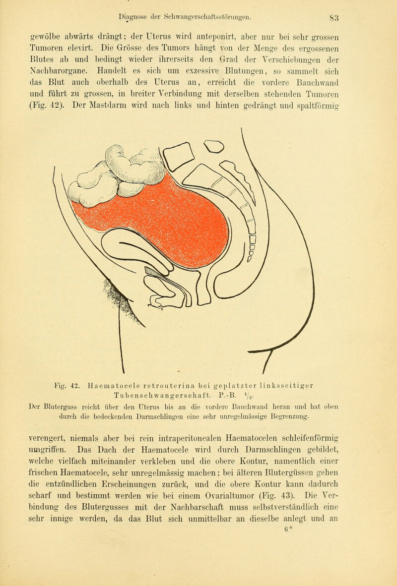 gewölbe abwärts drängt; der Uterus wird anteponirt, aber nur bei sehr grossen Tumoren elevirt. Die Grösse des Tumors hängt von der Menge des ergossenen Blutes ab und bedingt wieder ihrerseits den Grad der Verschiebungen der Nachbarorgane. Handelt es sich um exzessire Blutungen, so sammelt sich das Blut auch oberhalb des Uterus an, erreicht die vordere Bauchwand und führt zu grossen, in breiter Verbindung mit derselben stehenden Tumoren (Fig. 42). Der Mastdarm wird nach links und hinten gedrängt und spaltförmig Kg. 42. Haematocele retrouterina bei geplatzter linksseitiger Tubenschwangerschaft. P.-B. lj3. Der Bluterguss reicht über den Uterus bis an die vordere Bauchwand heran und hat oben durch die bedeckenden Darrnschlingen eine sehr unregelmässige Begrenzung. verengert, niemals aber bei rein intraperitonealen Haematocelen schleifenförmig umgriffen. Das Dach der Haematocele wird durch Darmschlingen gebildet, welche vielfach miteinander verkleben und die obere Kontur, namentlich einer frischen Haematocele, sehr unregelmässig machen; bei älteren Blutergüssen gehen die entzündlichen Erscheinungen zurück, und die obere Kontur kann dadurch scharf und bestimmt werden wie bei einem Ovarialtumor (Fig. 43). Die Ver- bindung des Blutergusses mit der Nachbarschaft muss selbstverständlich eine sehr innige werden, da das Blut sich unmittelbar an dieselbe anlegt und an 6*