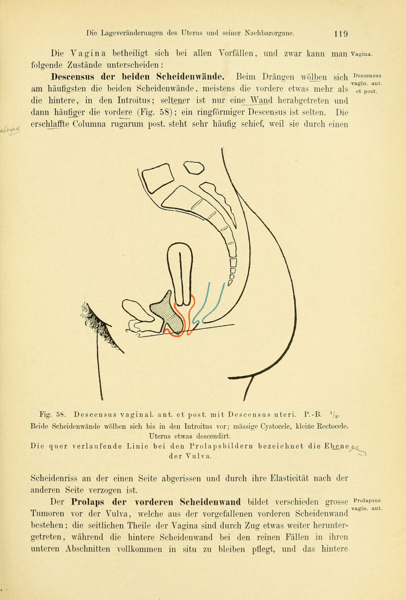 Die Vagina betheiligt sich bei allen Vorfällen, nnd zwar kann man Vagina, folgende Zustände unterscheiden: Descensus der beiden Scheidenwände. Beim Drängen wölben sich 'o^^3^ am häufigsten die beiden Scheidenwände, meistens die vordere etwas mehr als et Post. die hintere, in den Introitus; seltener ist nur eine Wand herabgetreten und dann häufiger die vordere (Fig. 58); ein ringförmiger Descensus ist selten. Die erschlaffte Columna rugarum post. steht sehr häufig schief, weil sie durch einen Fig. 58. Descensus vaginal, ant. et post. mit Descensus uteri. P.-B. 1/3. Beide Scheidenwände wölben sich bis in den Introitus vor; massige Cystocele, kleine Eectocele Uterus etwas descendirt. Die quer verlaufende Linie bei den Prolapsbildern bezeichnet die Ebe.ne*^ der Vulva. f Scheidenriss an der einen Seite abgerissen und durch ihre Elasticität nach der anderen Seite verzogen ist. Der Prolaps der vorderen Scheidenwand bildet verschieden grosse Pr°lapsus Tumoren vor der Vulva, welche aus der vorgefallenen vorderen Scheidenwand bestehen; die seitlichen Theile der Vagina sind durch Zug etwas weiter herunter- getreten, während die hintere Scheidenwand bei den reinen Fällen in ihren unteren Abschnitten vollkommen in situ zu bleiben pflegt, und das hintere