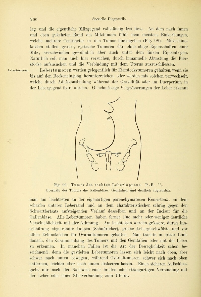 lag und die eigentliche Milzgegend vollständig frei liess. An dem nach innen und oben gekehrten Rand des Milztumors fühlt man meistens Einkerbungen, welche mehrere Centimeter in den Tumor hineingehen (Fig. 98). Milzechino- kokken stellen grosse, cystische Tumoren dar ohne obige Eigenschaften einer Milz, verschwinden gewöhnlich aber auch unter dem linken Rippenbogen. Natürlich soll man auch hier versuchen, durch bimanuelle Abtastung die Eier- stöcke aufzusuchen und die Verbindung mit dem Uterus auszuschliessen. Lebertumoren. L e b e i tu m o l en werden gelegentlich für Eierstockstumoren gehalten, wenn sie bis auf den Beckeneingang herunterreichen, oder werden mit solchen verwechselt, welche durch Adhäsionsbildung während der Gravidität oder im Puerperium in der Lebergegend flxirt werden. Gleichmässige Vergrösserungen der Leber erkennt Fig. 99. Tumor des rechten Leberlappens. P.-B. 1/0. Oberhalb des Tumors die Gallenblase; Genitalien sind deutlich abgrenzbar. man am leichtesten an der eigenartigen parenchymatösen Konsistenz, an dem scharfen unteren Leberrand und an dem charakteristischen schräg gegen den Schwertfortsatz aufsteigenden Verlauf desselben und an der Incisur für die Gallenblase. Alle Lebertumoren haben femer eine mehr oder weniger deutliche Verschieblichkeit mit der Athmung. Am leichtesten werden grössere, durch Ein- schnürung abgetrennte Lappen (Schnürleber), grosse Lebergeschwülste und vor allem Echinokokken für Ovarialtumoren gehalten. Man trachte in erster Linie danach, den Zusammenhang des Tumors mit den Genitalien oder mit der Leber zu erkennen. In manchen Eällen ist die Art der Beweglichkeit schon be- zeichnend, denn die gestielten Lebertumoren lassen sich leicht nach oben, aber schwer nach unten bewegen, während Ovarialtumoren schwer sich nach oben entfernen, leichter aber nach unten dislociren lassen. Einen sicheren Aufschluss giebt nur noch der Nachweis einer breiten oder strangartigen Verbindung mit der Leber oder einer Stielverbindung zum Uterus.