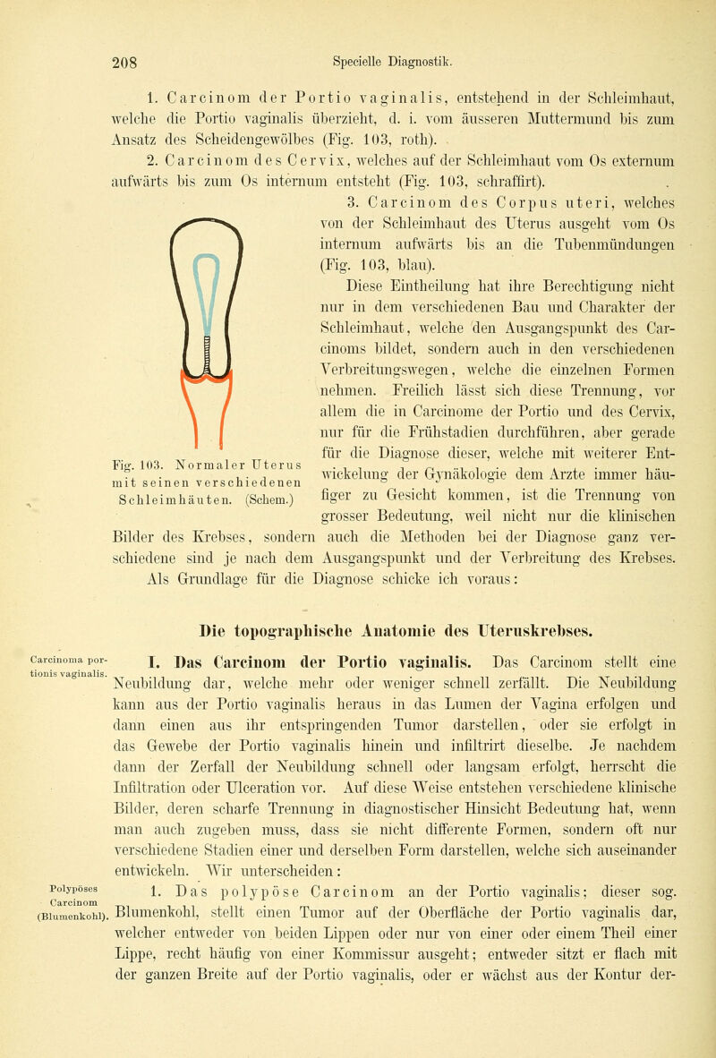 1. Carcinom der Portio vaginalis, entstellend in der Schleimhaut, welche die Portio vaginalis überzieht, d. i. vom äusseren Muttermund bis zum Ansatz des Scheidengewölbes (Fig. 103, roth). 2. Carcinom des Cervix, welches auf der Schleimhaut vom Os extemum aufwärts bis zum Os internum entsteht (Fig. 103, schraffirt). 3. Carcinom des Corpus uteri, welches von der Schleimhaut des Uterus ausgeht vom Os internum aufwärts bis an die Tubenmündungen (Fig. 103, blau). Diese Eintheilung hat ihre Berechtigung nicht nur in dem verschiedenen Bau und Charakter der Schleimhaut, welche den Ausgangspunkt des Car- cinoms bildet, sondern auch in den verschiedenen Verbreitungswegen, welche die einzelnen Formen nehmen. Freilich lässt sich diese Trennung, vor allem die in Carcinome der Portio und des Cervix, nur für die Frühstadien durchführen, aber gerade für die Diagnose dieser, welche mit weiterer Ent- Fig\ 103. Normaler Uterus . , , , ~ .., , . , ... , .. r, , . , Wickelung der Gynäkologie dem Arzte immer hau- mit seinen verschiedenen ° J ° Schleimhäuten. (Sehern.) %er zu Gesicht kommen, ist die Trennung von grosser Bedeutung, weil nicht nur die klinischen Bilder des Krebses, sondern auch die Methoden bei der Diagnose ganz ver- schiedene sind je nach dem Ausgangspunkt und der Verbreitung des Krebses. Als Grundlage für die Diagnose schicke ich voraus: Die topographische Anatomie des Uteruskreuses. Carcinoma Por- x. Das Carcinom der Portio vaginalis. Das Carcinom stellt eine ' Neubildung dar, welche mehr oder weniger schnell zerfällt. Die Neubildung kann aus der Portio vaginalis heraus in das Lumen der Vagina erfolgen und dann einen aus ihr entspringenden Tumor darstellen, oder sie erfolgt in das Gewebe der Portio vaginalis hinein und infiltrirt dieselbe. Je nachdem dann der Zerfall der Neubildung schnell oder langsam erfolgt, herrscht die Infiltration oder Ulceration vor. Auf diese Weise entstehen verschiedene klinische Bilder, deren scharfe Trennung in diagnostischer Hinsicht Bedeutung hat, wenn man auch zugeben muss, dass sie nicht differente Formen, sondern oft nur verschiedene Stadien einer und derselben Form darstellen, welche sich auseinander entwickeln. Wir unterscheiden: polypöses i j)as polypöse Carcinom an der Portio vaginalis; dieser sog. (Blumenkohl). Blumenkohl, stellt einen Tumor auf der Oberfläche der Portio vaginalis dar, welcher entweder von. beiden Lippen oder nur von einer oder einem Theil einer Lippe, recht häufig von einer Kommissur ausgeht; entweder sitzt er flach mit der ganzen Breite auf der Portio vaginalis, oder er wächst aus der Kontur der-