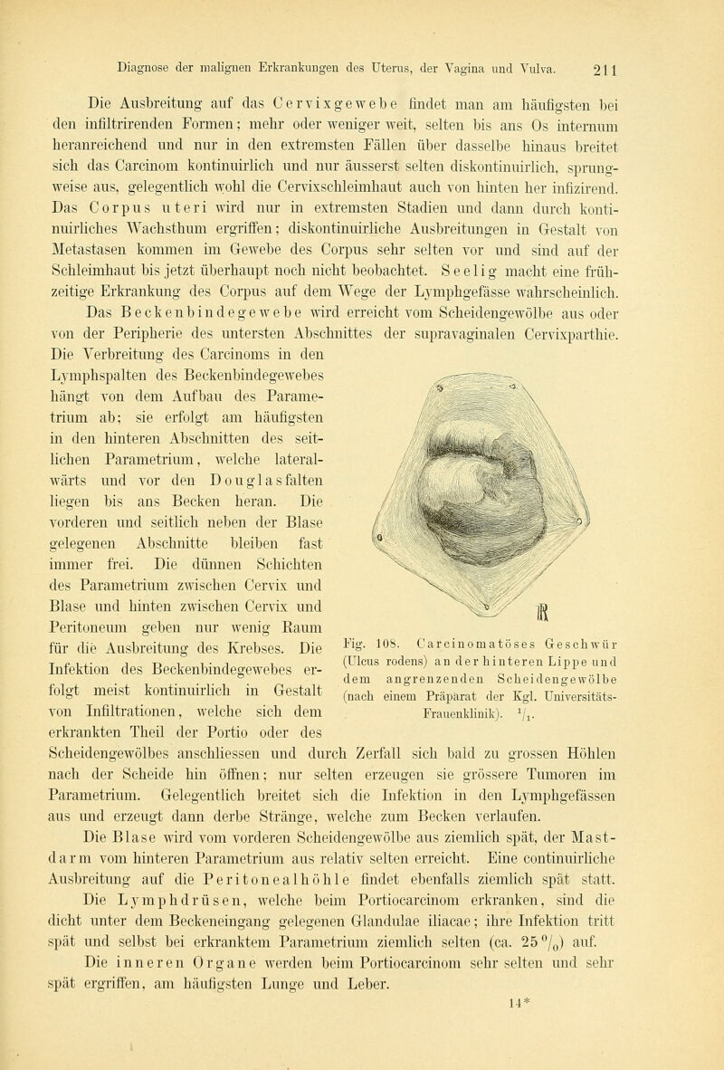 Die Ausbreitung auf das Cervixgewebe findet man am häufigsten bei den infiltrirenden Formen; mehr oder weniger weit, selten bis ans Os internum heranreichend und nur in den extremsten Fällen über dasselbe hinaus breitet sich das Carcinom kontinuirlich und nur äusserst selten diskontinuirlich, sprung- weise aus, gelegentlich wohl die Cervixschleimhaut auch von hinten her infizirend. Das Corpus uteri wird nur in extremsten Stadien und dann durch konti- nuirliches Wachsthum ergriffen; diskontinuirliche Ausbreitungen in Gestalt von Metastasen kommen im Gewebe des Corpus sehr selten vor und sind auf der Schleimhaut bis jetzt überhaupt noch nicht beobachtet. S e e 1 i g macht eine früh- zeitige Erkrankung des Corpus auf dem Wege der Lymphgefässe wahrscheinlich. Das Beckenbindegewebe wird erreicht vom Scheidengewölbe aus oder von der Peripherie des untersten Abschnittes der supravaginalen Cervixparthie. Die Verbreitung des Carcinoms in den Lymphspalten des Beckenbindegewebes ^--—: —- hängt von dem Aufbau des Parame- / \ trium ab; sie erfolgt am häufigsten in den hinteren Abschnitten des seit- '/:kisMM \<ä liehen Parametrium, welche lateral- ; Wm^s^i - k wärts und vor (\<-\\ Douglasfalten /; JB§1 . '■** '', liegen bis ans Becken heran. Die vorderen und seitlich neben der Blase gelegenen Abschnitte bleiben fast immer frei. Die dünnen Schichten des Parametrium zwischen Cervix und Blase und hinten zwischen Cervix und g -m Peritoneum geben nur wenig Raum für die Ausbreitung des Krebses. Die V[S- 108- Carcinomatöses Geschwür T n , ,• -, -n t i- j i (Ulcus rodens) an der hinteren Lippe und Infektion des Beckenbindegewebes er- \ , «,.-,■,, ° dem angrenzenden Scheidengewölbe folgt meist kontmmrlich in Gestalt (nach einem Präpärat der KgL Universitäts. von Infiltrationen, welche sich dem Frauenklinik). Vi- erkrankten Theil der Portio oder des Scheidengewölbes anschliessen und durch Zerfall sich bald zu grossen Höhlen nach der Scheide hin öffnen; nur selten erzeugen sie grössere Tumoren im Parametrium. Gelegentlich breitet sich die Infektion in den Lymphgefässen aus und erzeugt dann derbe Stränge, welche zum Becken verlaufen. Die Blase wird vom vorderen Scheidengewölbe aus ziemlich spät, der Mast- darm vom hinteren Parametrium aus relativ selten erreicht. Eine continuirliche Ausbreitung auf die Peritonealhöhle findet ebenfalls ziemlich spät statt. Die Lymphdrüsen, welche beim Portiocarcinom erkranken, sind die dicht unter dem Beckeneingang gelegenen Glandulae iliacae; ihre Infektion tritt spät und selbst bei erkranktem Parametrium ziemlich selten (ca. 25%) auf. Die inneren Organe werden beim Portiocarcinom sehr selten und sehr spät ergriffen, am häufigsten Lunge und Leber. 14* X.