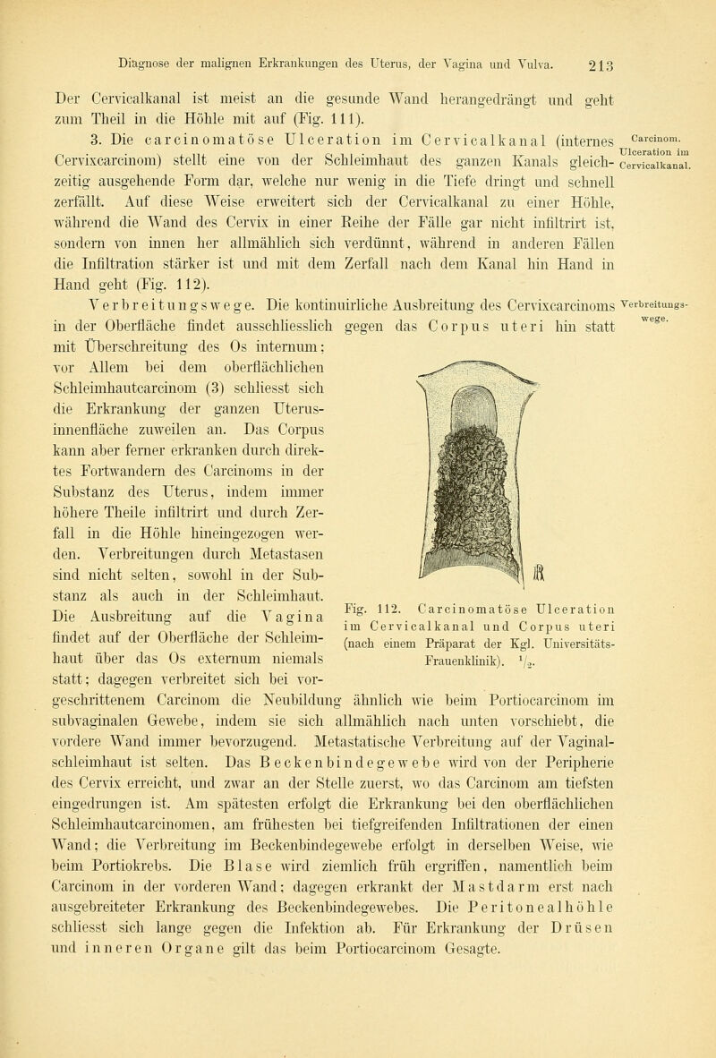 Der Cervicalkanäl ist meist an die gesunde Wand herangedrängt und geht zum Theil in die Höhle mit auf (Fig. 111). 3. Die carcinomatöse Ulceration im Cervicalkanäl (internes carcinom. Cervixcarcinom) stellt eine von der Schleimhaut des ganzen Kanals gleich- cervicalkanäl. zeitig ausgehende Form dar, welche nur wenig in die Tiefe dringt und schnell zerfällt. Auf diese Weise erweitert sich der Cervicalkanäl zu einer Höhle, während die Wand des Cervix in einer Eeihe der Fälle gar nicht infiltrirt ist, sondern von innen her allmählich sich verdünnt, während in anderen Fällen die Infiltration stärker ist und mit dem Zerfall nach dem Kanal hin Hand in Hand geht (Fig. 112). Verhreitungswege. Die kontinuirliche Ausbreitung des Cervixcarcinoms verbreitunga- in der Oberfläche findet ausschliesslich gegen das Corpus uteri hin statt mit Überschreitung des Os internum; vor Allem bei dem oberflächlichen Schleimhautcarcinom (3) schliesst sich die Erkrankung der ganzen Uterus- innenfläche zuweilen an. Das Corpus kann aber femer erkranken durch direk- tes Fortwandern des Carcinoms in der Substanz des Uterus, indem immer höhere Theile infiltrirt und durch Zer- fall in die Höhle hineingezogen wer- den. Verbreitungen durch Metastasen sind nicht selten, sowohl in der Sub- stanz als auch in der Schleimhaut. Die Ausbreitung auf die Vagina findet auf der Oberfläche der Schleim- haut über das Os extemum niemals statt; dagegen verbreitet sich bei vor- geschrittenem Carcinom die Neubildung ähnlich wie beim Portiocarcinom im subvaginalen Gewebe, indem sie sich allmählich nach unten vorschiebt, die vordere Wand immer bevorzugend. Metastatische Verbreitung auf der Vaginal- schleimhaut ist selten. Das Beckenbindegewebe wird von der Peripherie des Cervix erreicht, und zwar an der Stelle zuerst, wo das Carcinom am tiefsten eingedrungen ist. Am spätesten erfolgt die Erkrankung bei den oberflächlichen Schleimhautcarcinomen, am frühesten bei tiefgreifenden Infiltrationen der einen Wand; die Verbreitung im Beckenbindegewebe erfolgt in derselben Weise, wie beim Portiokrebs. Die Blase wird ziemlich früh ergriffen, namentlich beim Carcinom in der vorderen Wand; dagegen erkrankt der Mastdarm erst nach ausgebreiteter Erkrankung des Beckenbindegewebes. Die Peritonealhöhle schliesst sich lange gegen die Infektion ab. Für Erkrankung der Drüsen und inneren Organe gilt das beim Portiocarcinom Gesagte. Fig. 112. Carcinomatöse Ulceration im Cervicalkanäl und Corpus uteri (nach einem Präparat der Kgl. Universitäts- Frauenklinik). 1/.2.