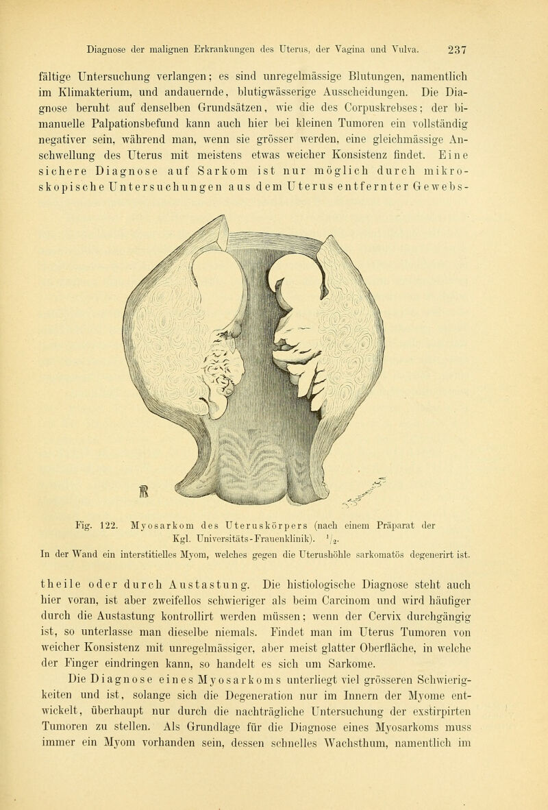 fältige Untersuchung verlangen; es sind unregelmässige Blutungen, namentlich im Klimakterium, und andauernde, blutigwässerige Ausscheidungen. Die Dia- gnose beruht auf denselben Grundsätzen, wie die des Corpuskrebses; der bi- manuelle Palpationsbefund kann auch hier bei kleinen Tumoren ein vollständig negativer sein, während man, wenn sie grösser werden, eine gleichmässige An- schwellung des Uterus mit meistens etwas weicher Konsistenz findet. Eine sichere Diagnose auf Sarkom ist nur möglich durch mikro- skopische Untersuchungen aus dem Uterus entfernter Gewebs- Fig. 122. Myosarkom des Uteruskörpers (nach einem Präparat der Kgl. Universitäts - Frauenklinik). 1/a. In der Wand ein interstitielles Myom, welches gegen die Uterushöhle sarkomatös degenerirt ist. theile oder durch Austastung. Die histiologische Diagnose steht auch hier voran, ist aber zweifellos schwieriger als beim Carcinom und wird häufiger durch die Austastung kontrollirt werden müssen; wenn der Cervix durchgängig ist, so unterlasse man dieselbe niemals. Findet man im Uterus Tumoren von weicher Konsistenz mit unregelmässiger, aber meist glatter Oberfläche, in welche der Finger eindringen kann, so handelt es sich um Sarkome. Die Diagnose eines Myosarkoms unterliegt viel grösseren Schwierig- keiten und ist, solange sich die Degeneration nur im Innern der Myome ent- wickelt, überhaupt nur durch die nachträgliche Untersuchung der exstirpirten Tumoren zu stellen. Als Grundlage für die Diagnose eines Myosarkoms muss immer ein Myom vorhanden sein, dessen schnelles Wachsthum, namentlich im