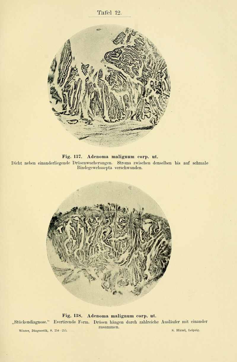 Fig. 137. Adenoma malignum corp. ut. Dicht neben einanderliegende Brüsenwucherungen. Stroma zwischen denselben bis auf schmale Bindegewebssepta verschwunden. - ~ ■■--■-■ f.■ \'vis ?vl A'i ''' i 1 Vi *■». V>i» Fig. 138. Adenoma malignum corp. ut. „Stückendiagnose. Evertirende Form. Drüsen hängen durch zahlreiche Ausläufer mit einander zusammen. Winter, Diagnostik, S. 254—255. S. Hirzel, Leipzig.