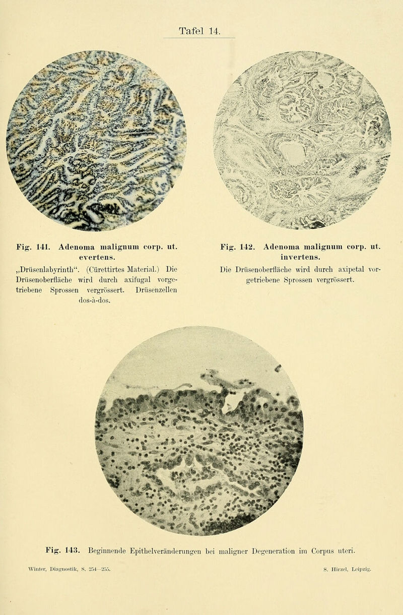 ^■***?^fc*s^ t:: ;■ *•-  _• ->' ■ .• •'■' :- . ■'.- > «»« ^ß Fig. 141. Adenoma malignum corp. ut. evertens. „Drüsenlabyrinth. (Cürettirtes Material.) Die Drüsenoberfläche wird durch axifugal vorge- triebene Sprossen vergrössert. Drüsenzellen dos-ä-dos. V* %t. ^ Fig. 142. Adenoma malignum corp. ut. invertens. Die Drüsenoberfläche wird durch axipetal vor- getriebene Sprossen vergrössert. •feFS?» MZ 9 Fig. 143. Beginnende Epithelveränderungen bei maligner Degeneration im Corpus uteri.