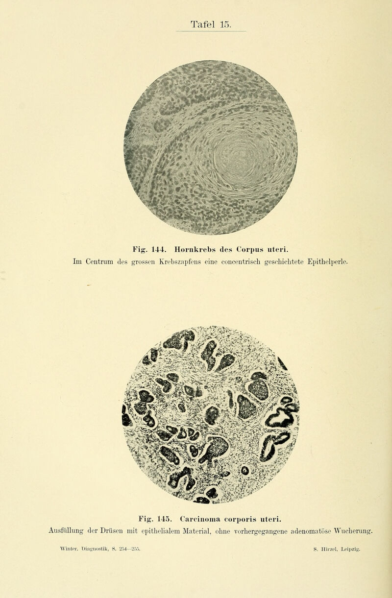 Fig. 144. Hornkrebs des Corpus uteri. Im Centrum des grossen Krebszapfens eine concentrisch geschichtete Epithelperle. HS - »-? f•■■P-P*£BSVi. ä^_ \<S? 3p Fig. 145. Carcinoma corporis uteri. Ausfüllung der Drüsen mit epithelialem Material, ohne vorhergegangene adenomatöse Wucherung.