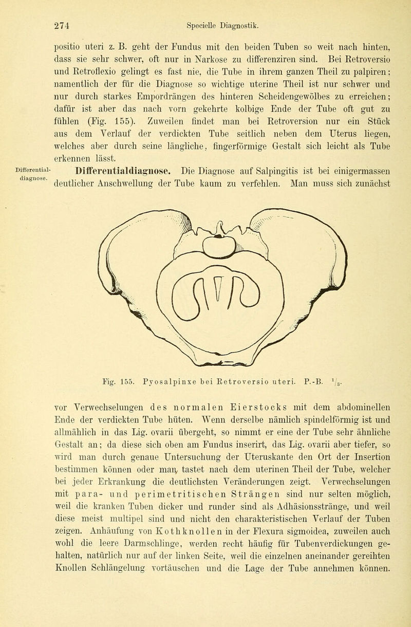 positio uteri z. B. geht der Fundus mit den beiden Tuben so weit nach hinten, dass sie sehr schwer, oft nur in Narkose zu differenziren sind. Bei Retroversio und Retroflexio gelingt es fast nie, die Tube in ihrem ganzen Theil zu palpiren: namentlich der für die Diagnose so wichtige uterine Theil ist nur schwer und nur durch starkes Empordrängen des hinteren Scheidengewölbes zu erreichen; dafür ist aber das nach vorn gekehrte kolbige Ende der Tube oft gut zu fühlen (Fig. 155). Zuweilen findet man bei Retroversion nur ein Stück aus dem Verlauf der verdickten Tube seitlich neben dem Uterus liegen, welches aber durch seine längliche, fingerförmige Gestalt sich leicht als Tube erkennen lässt. Differential- Differeiitialdiagnose. Die Diagnose auf Salpingitis ist bei einigermassen deutlicher Anschwellung der Tube kaum zu verfehlen. Man muss sich zunächst Fig. 155. Pyosalpinxe bei Retroversio uteri. P.-B. 1/3. vor Verwechselungen des normalen Eierstocks mit dem abdominellen Ende der verdickten Tube hüteo. Wenn derselbe nämlich spindelförmig ist und allmählich in das Lig. ovarii übergeht, so nimmt er eine der Tube sehr ähnliche Gestalt an; da diese sich oben am Fundus inserirt, das Lig. ovarii aber tiefer, so wird man durch genaue Untersuchung der Uteruskante den Ort der Insertion bestimmen können oder man, tastet nach dem uterinen Theil der Tube, welcher bei jeder Erkrankung die deutlichsten Veränderungen zeigt. Verwechselungen mit para- und perimetritischen Strängen sind nur selten möglich, weil die kranken Tuben dicker und runder sind als Adhäsionsstränge, und weil diese meist multipel sind und nicht den charakteristischen Verlauf der Tuben zeigen. Anhäufung von Kothknollenin der Flexura sigmoidea, zuweilen auch wohl die leere Darmschlinge, werden recht häufig für Tubenverdickungen ge- halten, natürlich nur auf der linken Seite, weil die einzelnen aneinander gereihten Knollen Schlängelung vortäuschen und die Lage der Tube annehmen können.