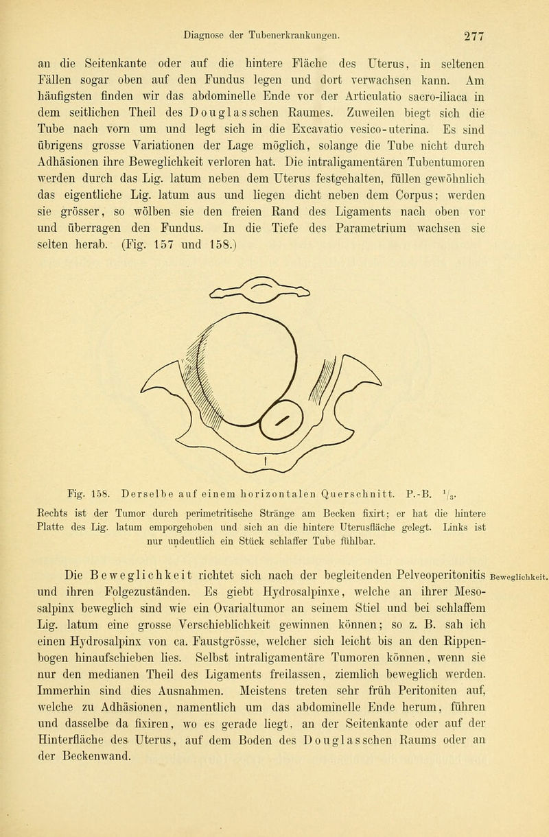 an die Seitenkante oder auf die hintere Fläche des Uterus, in seltenen Fällen sogar oben auf den Fundus legen und dort verwachsen kann. Am häufigsten finden wir das abdominelle Ende vor der Articulatio sacro-iliaca in dem seitlichen Theil des Douglas sehen Raumes. Zuweilen biegt sich die Tube nach vorn um und legt sich in die Excavatio vesico-uterina. Es sind übrigens grosse Variationen der Lage möglich, solange die Tube nicht durch Adhäsionen ihre Beweglichkeit verloren hat. Die intraligamentären Tubentumoren werden durch das Lig. latum neben dem Uterus festgehalten, füllen gewöhnlich das eigentliche Lig. latum aus und liegen dicht neben dem Corpus; werden sie grösser, so wölben sie den freien Rand des Ligaments nach oben vor und überragen den Fundus. In die Tiefe des Parametrium wachsen sie selten herab. (Fig. 157 und 158.) Fig. 158. Derselbe auf einem horizontalen Querschnitt. P.-B. 1/3. Eechts ist der Tumor durch perimetritische Stränge am Becken fixirt; er hat die hintere Platte des Lig. latum emporgehoben und sich an die hintere Uterusfiäche gelegt. Links ist nur undeutlich ein Stück schlaffer Tube fühlbar. Die Beweglichkeit richtet sich nach der begleitenden Pelveoperitonitis Beweglichkeit. und ihren Folgezuständen. Es giebt Hydrosalpinxe, welche an ihrer Meso- salpinx beweglich sind wie ein Ovarialtumor an seinem Stiel und bei schlaffem Lig. latum eine grosse Verschieblichkeit gewinnen können; so z. B. sah ich einen Hydrosalpinx von ca. Faustgrösse, welcher sich leicht bis an den Rippen- bogen hinaufschieben lies. Selbst intraligamentäre Tumoren können, wenn sie nur den medianen Theil des Ligaments freilassen, ziemlich beweglich werden. Immerhin sind dies Ausnahmen. Meistens treten sehr früh Peritoniten auf, welche zu Adhäsionen, namentlich um das abdominelle Ende herum, führen und dasselbe da fixiren, wo es gerade liegt, an der Seitenkante oder auf der Hinterfläche des Uterus, auf dem Boden des Douglas sehen Raums oder an der Beckenwand.