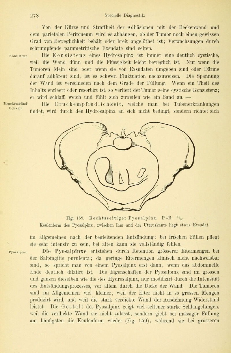 Konsistenz. TJruckempfind- lichkeit. Von der Kürze und Straffheit der Adhäsionen mit der Beckenwand und dem parietalen Peritoneum wird es abhängen, ob der Tumor noch einen gewissen Grad von Beweglichkeit behält oder breit angelöthet ist; Verwachsungen durch schrumpfende parametritische Exsudate sind selten. Die Konsistenz eines Hydrosalpinx ist immer eine deutlich cystische, weil die Wand dünn und die Flüssigkeit leicht beweglich ist. Nur wenn die Tumoren klein sind oder wenn sie von Exsudaten umgeben sind oder Därme darauf adhärent sind, ist es schwer, Fluktuation nachzuweisen. Die Spannung der Wand ist verschieden nach dem Grade der Füllung. Wenn ein Theil des Inhalts entleert oder resorbirt ist, so verliert der Tumor seine cystische Konsistenz; er wird schlaff, weich und fühlt sich zuweilen wie ein Band an. — Die Druckempfindlichkeit, welche man bei Tubenerkrankungen findet, wird durch den Hydrosalpinx an sich nicht bedingt, sondern richtet sich Fig. 159. Rechtsseitiger Pyosalpinx. P.-B. 1/3. Keulenforni des Pjosalpinx; zwischen ihm nnd der Uteruskante hegt etwas Exsudat. im allgemeinen nach der begleitenden Entzündung; bei frischen Fällen pflegt sie sehr intensiv zu sein, bei alten kann sie vollständig fehlen, pyosalpinx. Die Pyosalpinxe entstehen durch Betention grösserer Eitermengen bei der Salpingitis purulenta; da geringe Eitermengen klinisch nicht nachweisbar sind, so spricht man von einem Pyosalpinx erst dann, wenn das abdominelle Ende deutlich dilatirt ist. Die Eigenschaften der Pyosalpinx sind im grossen und ganzen dieselben wie die des Hydrosalpinx, nur modifizirt durch die Intensität des Entzündungsprozesses, vor allem durch die Dicke der Wand. Die Tumoren sind im Allgemeinen viel kleiner, weil der Eiter nicht in so grossen Mengen produzirt wird, und weil die stark verdickte Wand der Ausdehnung Widerstand leistet. Die Gestalt des Pyosalpinx zeigt viel seltener starke Schlängelungen, weil die verdickte Wand sie nicht zulässt, sondern giebt bei massiger Füllung am häufigsten die Keulenform wieder (Fig. 159), während sie bei grösseren