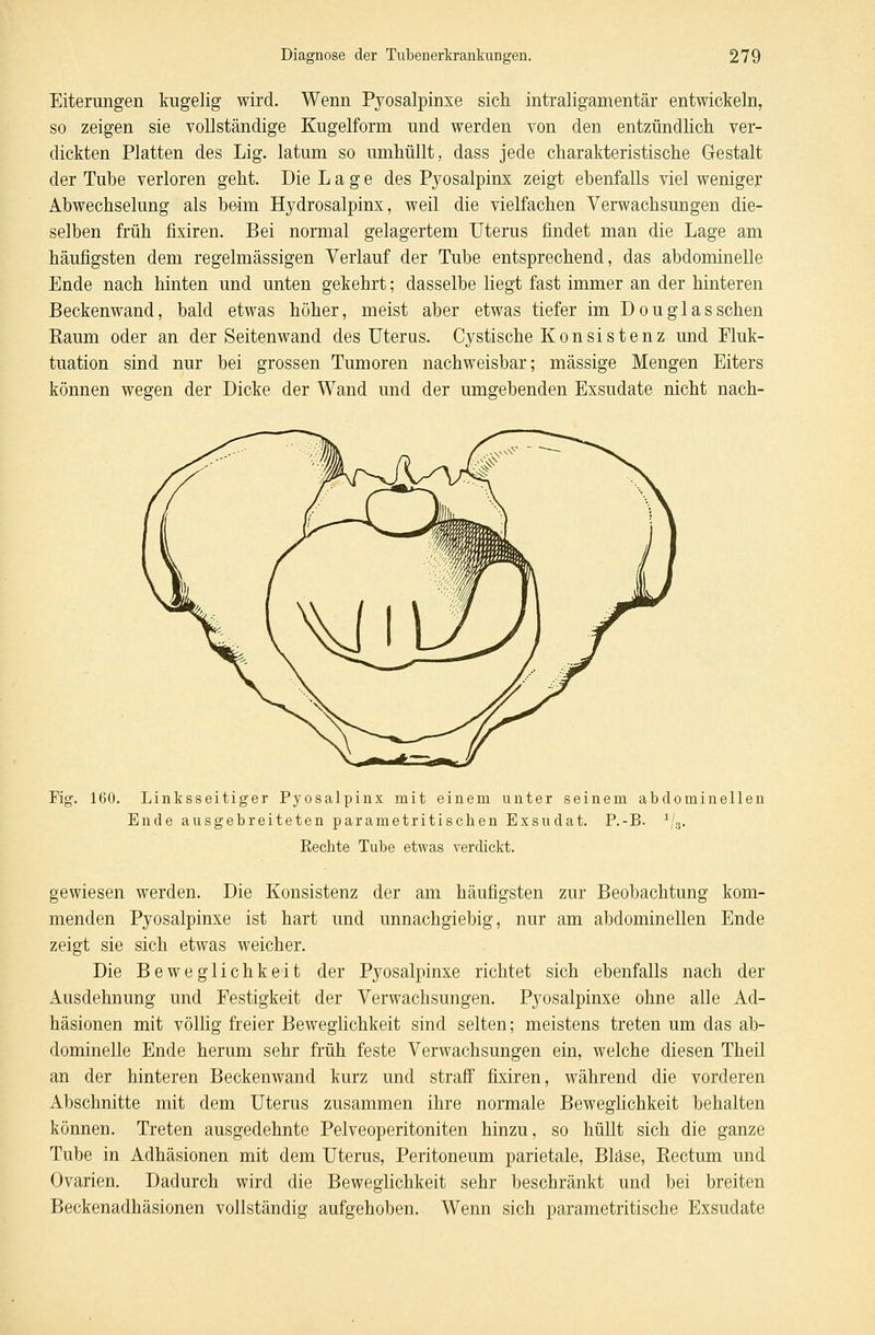 Eiterungen kugelig wird. Wenn Pyosalpinxe sich intraligamentär entwickeln, so zeigen sie vollständige Kugelform und werden von den entzündlich ver- dickten Platten des Lig. latum so umhüllt, dass jede charakteristische Gestalt der Tube verloren geht. Die Lage des Pyosalpinx zeigt ebenfalls viel weniger Abwechselung als beim Hydrosalpinx, weil die vielfachen Verwachsungen die- selben früh fixiren. Bei normal gelagertem Uterus findet man die Lage am häufigsten dem regelmässigen Verlauf der Tube entsprechend, das abdominelle Ende nach hinten und unten gekehrt; dasselbe liegt fast immer an der hinteren Beckenwand, bald etwas höher, meist aber etwas tiefer im Douglas sehen Raum oder an der Seitenwand des Uterus. Cystische Konsistenz und Fluk- tuation sind nur bei grossen Tumoren nachweisbar; massige Mengen Eiters können wegen der Dicke der Wand und der umgebenden Exsudate nicht nach- Fig. 160. Linksseitiger Pyosalpinx mit einem unter seinem abdominellen Ende ausgebreiteten parametritiseben Exsu dat. P.-B. 1/3. Recbte Tube etwas verdickt. gewiesen werden. Die Konsistenz der am häufigsten zur Beobachtung kom- menden Pyosalpinxe ist hart und unnachgiebig, nur am abdominellen Ende zeigt sie sich etwas weicher. Die Beweglichkeit der Pyosalpinxe richtet sich ebenfalls nach der Ausdehnung und Festigkeit der Verwachsungen. Pyosalpinxe ohne alle Ad- häsionen mit völlig freier Beweglichkeit sind selten; meistens treten um das ab- dominelle Ende herum sehr früh feste Verwachsungen ein, welche diesen Theil an der hinteren Beckenwand kurz und straff fixiren, während die vorderen Abschnitte mit dem Uterus zusammen ihre normale Beweglichkeit behalten können. Treten ausgedehnte Pelveoperitoniten hinzu, so hüllt sich die ganze Tube in Adhäsionen mit dem Uterus, Peritoneum parietale, Blase, Rectum und Ovarien. Dadurch wird die Beweglichkeit sehr beschränkt und bei breiten Beckenadhäsionen vollständig aufgehoben. Wenn sich parametritische Exsudate