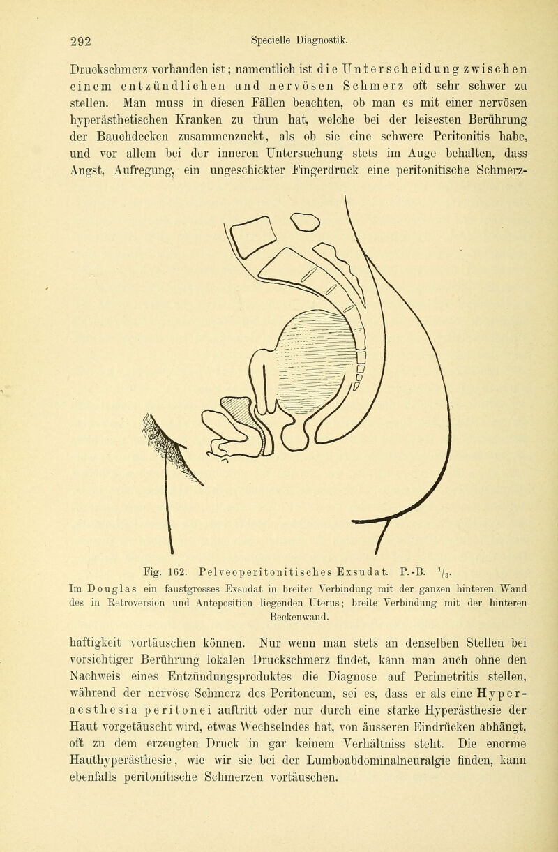Druckschmerz vorhanden ist; namentlich istdieUnterscheidungzwischen einem entzündlichen und nervösen Schmerz oft sehr schwer zu stellen. Man muss in diesen Fällen beachten, ob man es mit einer nervösen hyperästhetischen Kranken zu thun hat, welche bei der leisesten Berührung der Bauchdecken zusammenzuckt, als ob sie eine schwere Peritonitis habe, und vor allem bei der inneren Untersuchung stets im Auge behalten, dass Angst, Aufregung, ein ungeschickter Fingerdruck eine peritonitische Schmerz- Fig. 162. Pelveoperitonitisches Exsudat. P.-B. x\z. Im D o u g 1 a s ein faustgrosses Exsudat in breiter Verbindung mit der ganzen hinteren Wand des in Eetroversion und Anteposition liegenden Uterus; breite Verbindung mit der hinteren Beckenwand. haftigkeit vortäuschen können. Nur wenn man stets an denselben Stellen bei vorsichtiger Berührung lokalen Druckschmerz findet, kann man auch ohne den Nachweis eines Entzündungsproduktes die Diagnose auf Perimetritis stellen, während der nervöse Schmerz des Peritoneum, sei es, dass er als eine H y p e r - aesthesia peritonei auftritt oder nur durch eine starke Hyperästhesie der Haut vorgetäuscht wird, etwas Wechselndes hat, von äusseren Eindrücken abhängt, oft zu dem erzeugten Druck in gar keinem Verhältniss steht. Die enorme Hauthyperästhesie, wie wir sie bei der Lumboabdominalneuralgie finden, kann ebenfalls peritonitische Schmerzen vortäuschen.