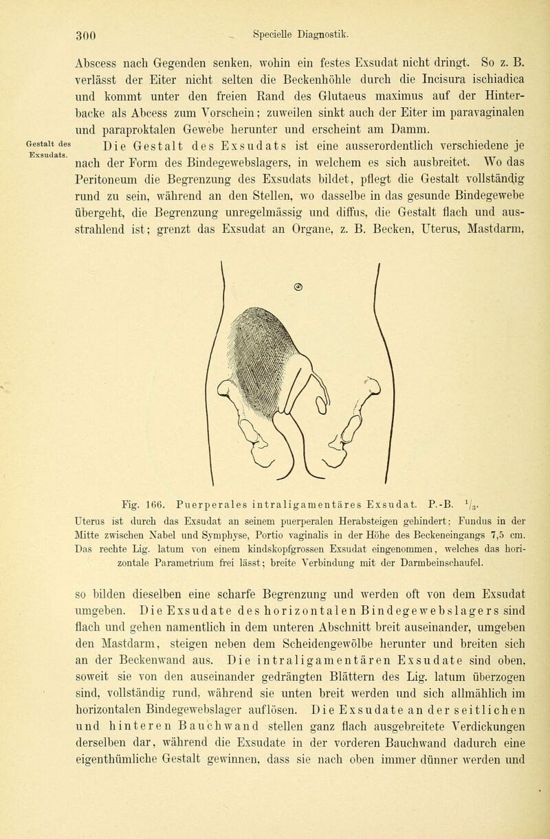 Gestalt des Exsudats. Abscess nach Gegenden senken, wohin ein festes Exsudat nicht dringt. So z. B. verlässt der Eiter nicht selten die Beckenhöhle durch die Incisura ischiadica und kommt unter den freien Rand des Glutaeus maximus auf der Hinter- backe als Abcess zum Vorschein; zuweilen sinkt auch der Eiter im paravaginalen und paraproktalen Gewebe herunter und erscheint am Damm. Die Gestalt des Exsudats ist eine ausserordentlich verschiedene je nach der Eorm des Bindegewebslagers, in welchem es sich ausbreitet. Wo das Peritoneum die Begrenzung des Exsudats bildet, pflegt die Gestalt vollständig rund zu sein, während an den Stellen, wo dasselbe in das gesunde Bindegewebe übergeht, die Begrenzung unregelmässig und diffus, die Gestalt flach und aus- strahlend ist; grenzt das Exsudat an Organe, z. B. Becken, Uterus, Mastdarm, Fig. 166. Puerperales intraliganientäres Exsudat. P.-B. 1/3. Uterus ist durch das Exsudat an seinem puerperalen Herabsteigen gehindert: Fundus in der Mitte zwischen Nabel und Symphyse, Portio vaginalis in der Höhe des Beckeneingangs 7,5 cm. Das rechte Lig. latum von einem kindskopfgrossen Exsudat eingenommen, welches das hori- zontale Parametrium frei lässt; breite Verbindung mit der Darmbeinschaufel. so bilden dieselben eine scharfe Begrenzung und werden oft von dem Exsudat umgeben. DieExsudate deshorizontalenBindegewebslagers sind flach und gehen namentlich in dem unteren Abschnitt breit auseinander, umgeben den Mastdarm, steigen neben dem Scheidengewölbe herunter und breiten sich an der Beckenwand aus. Die intraligamentären Exsudate sind oben, soweit sie von den auseinander gedrängten Blättern des Lig. latum überzogen sind, vollständig rund, während sie unten breit werden und sich allmählich im horizontalen Bindegewebslager auflösen. Die Exsudate an der seitlichen und hinteren Bauchwand stellen ganz flach ausgebreitete Verdickungen derselben dar, während die Exsudate in der vorderen Bauchwand dadurch eine eigenthümliche Gestalt gewinnen, dass sie nach oben immer dünner werden und